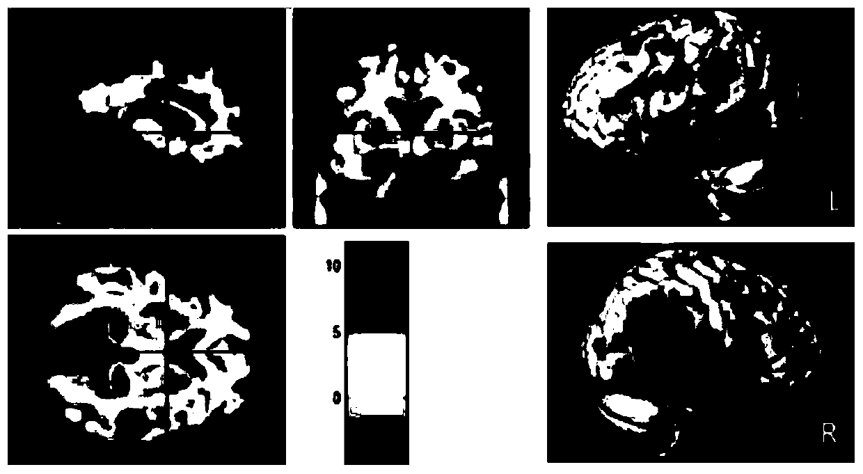 An Alzheimer's disease MRI image classification method based on an SVM-RFE-MRMR algorithm