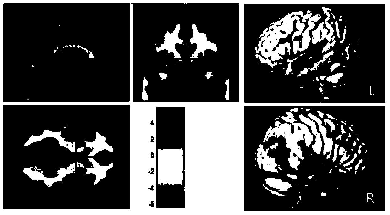 An Alzheimer's disease MRI image classification method based on an SVM-RFE-MRMR algorithm
