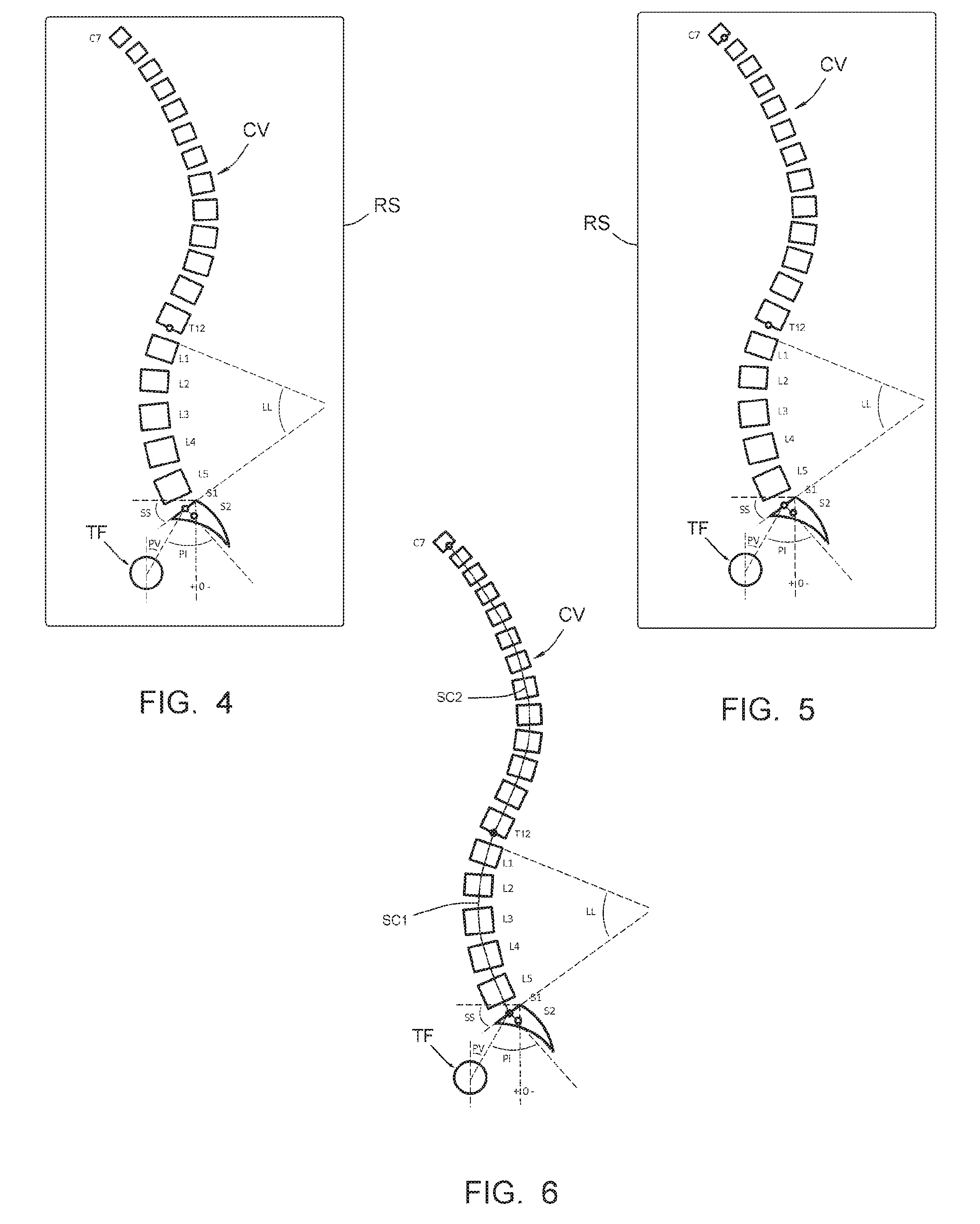 Method making it possible to produce the ideal curvature of a rod of vertebral osteosynthesis material designed to support a patient vertebral column