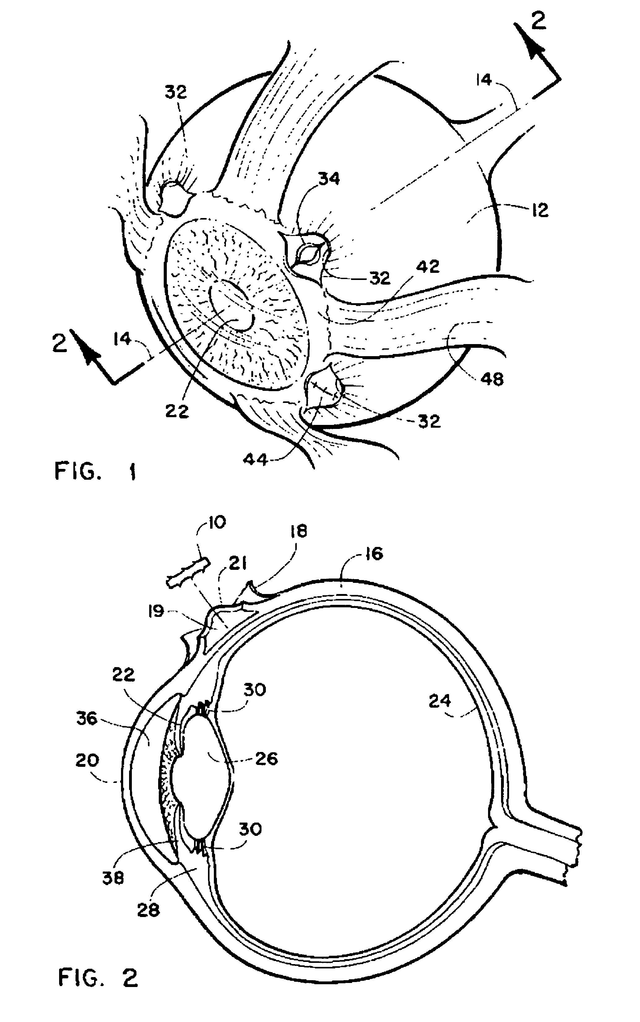 Method and intra sclera implant for treatment of glaucoma and presbyopia