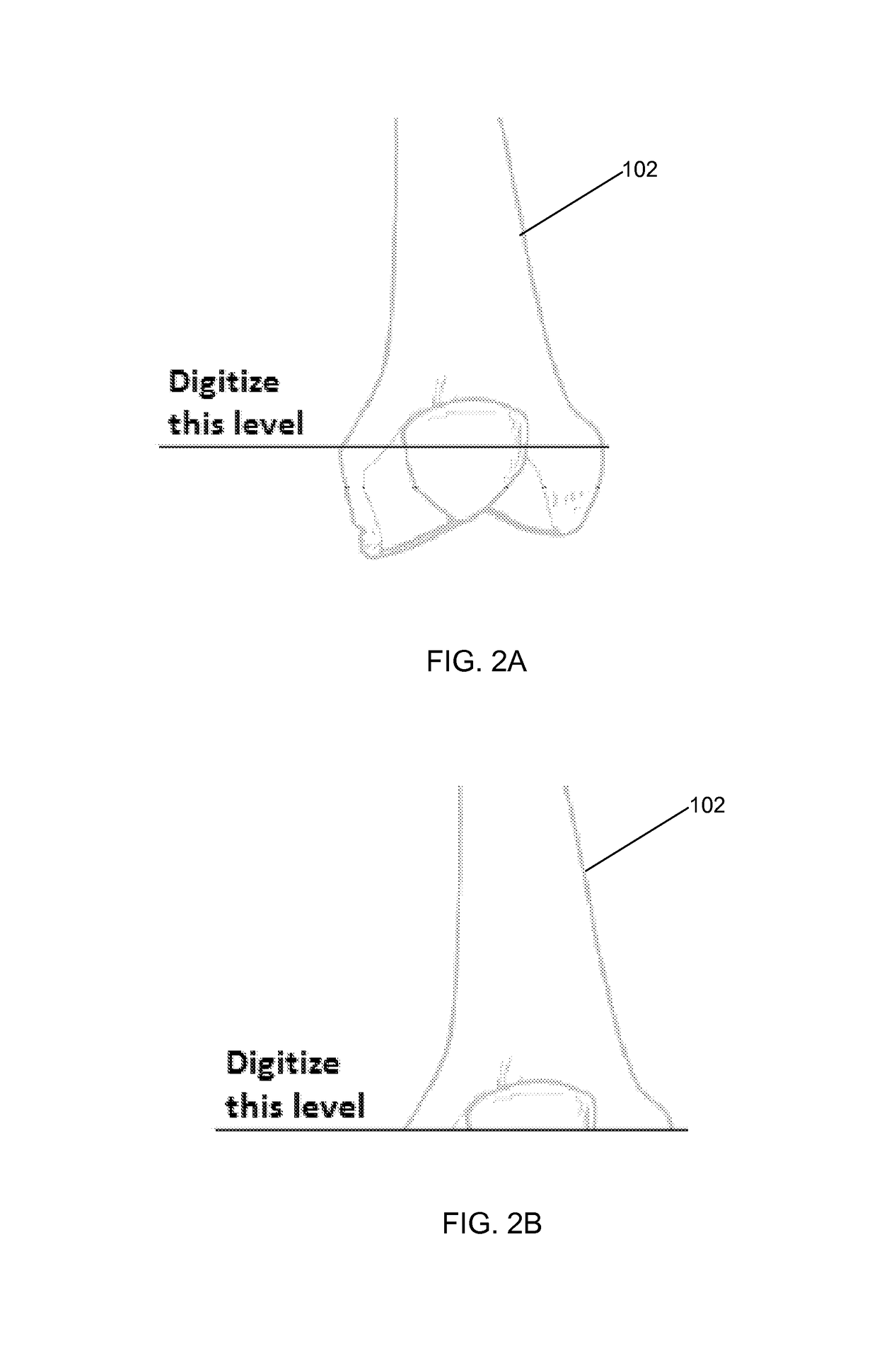 Implant based planning, digitizing, and registration for total joint arthroplasty