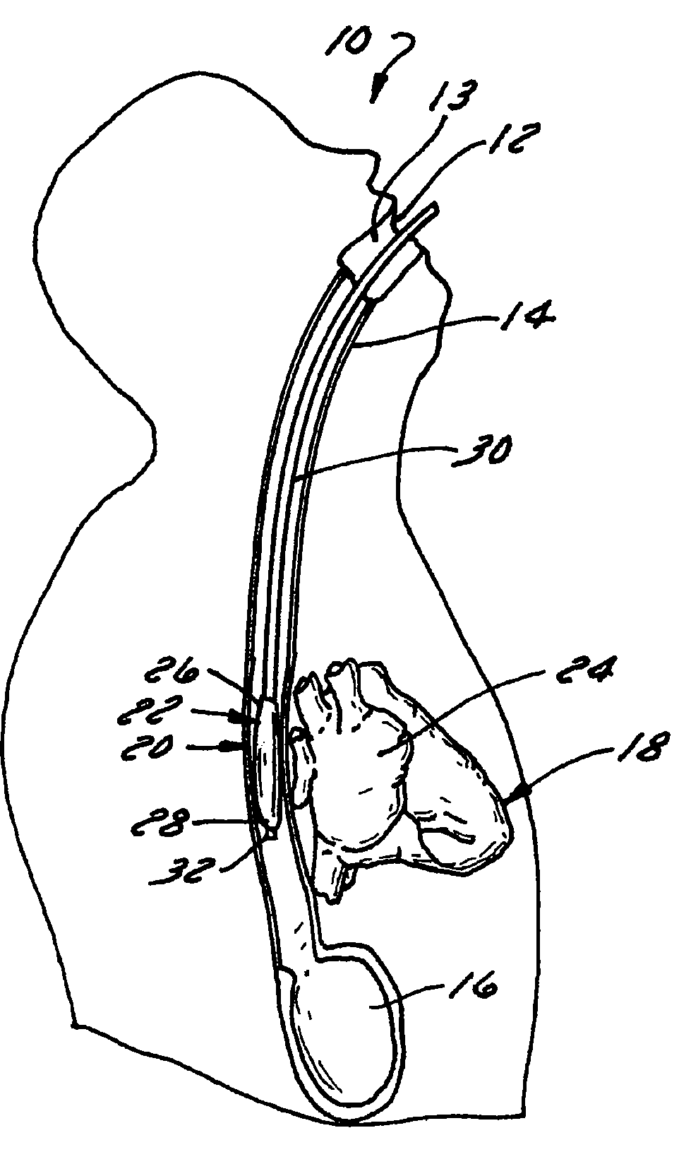 Intra-esophageal balloon system