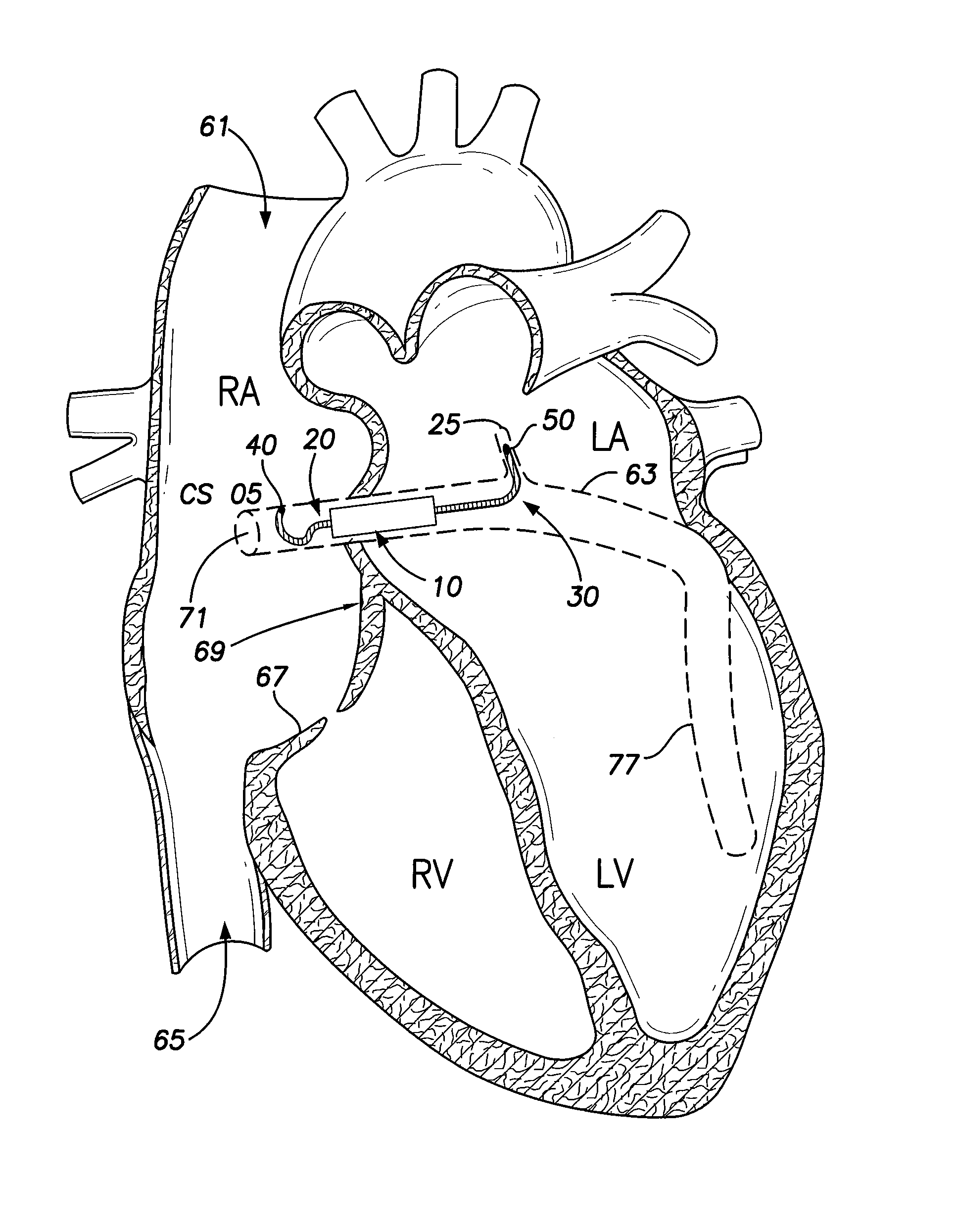 Intracardiac implantable medical device for biatrial and/or left heart pacing and method of implanting same