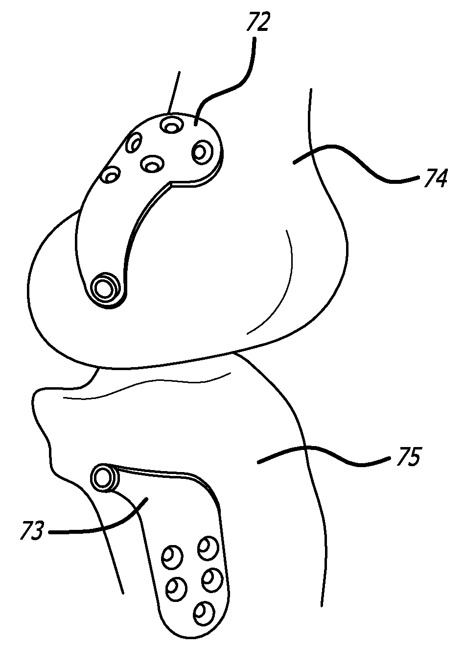 Extra-articular implantable mechanical energy absorbing systems and implantation method