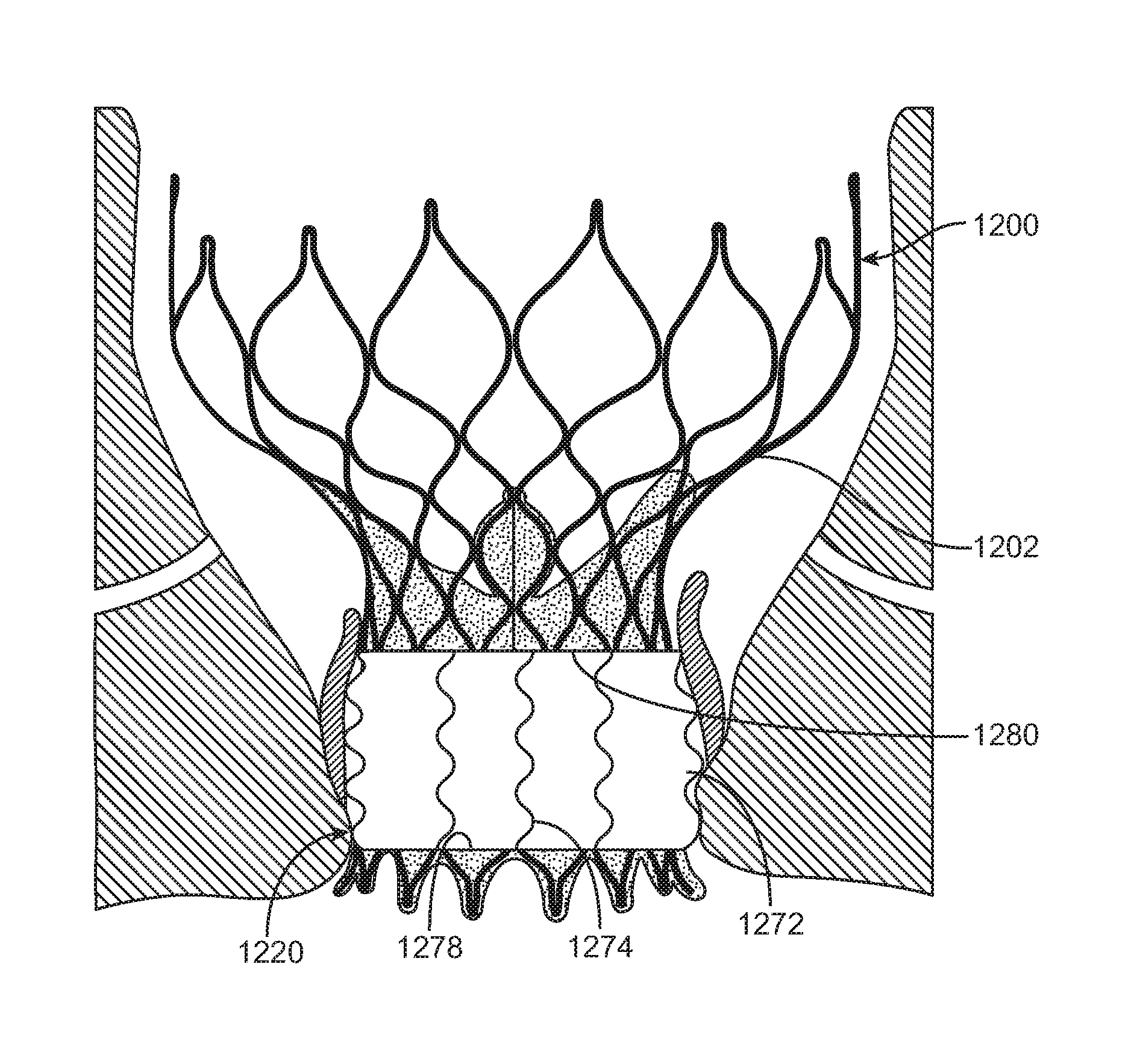 Transcatheter valve prosthesis and a concurrently delivered sealing component