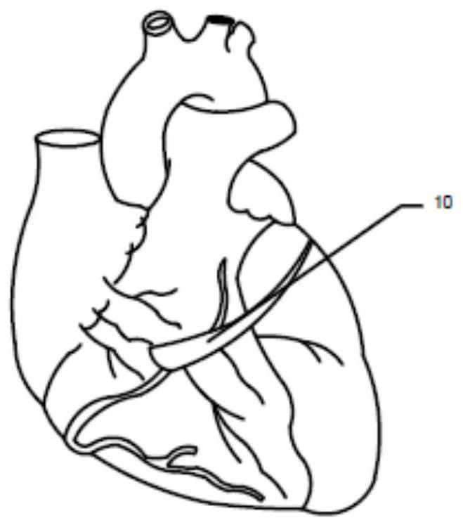 Cardiac pacemaker lead capable of preventing slippage