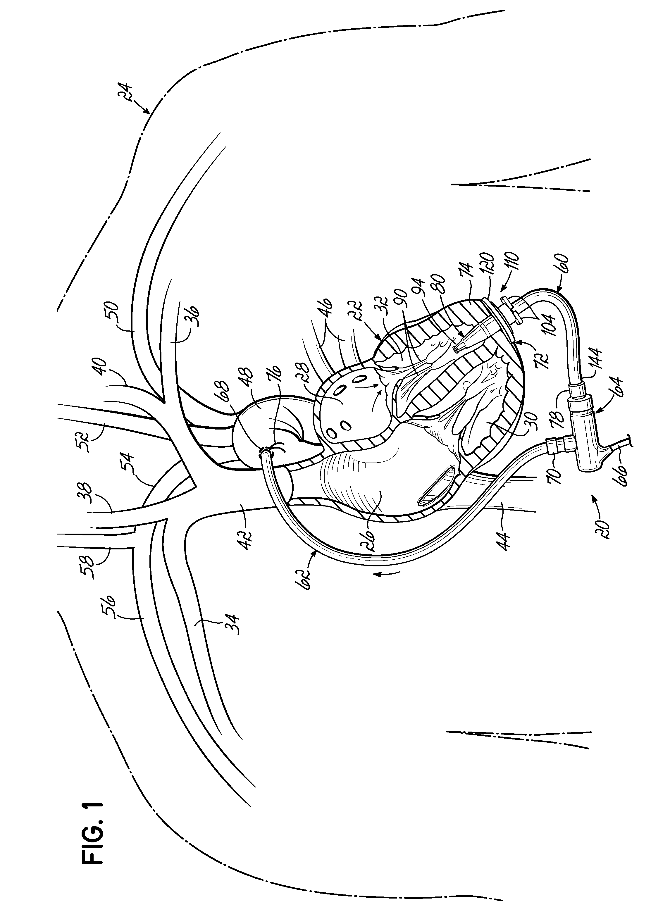 Cannula tips, tissue attachment rings, and methods of delivering and using the same