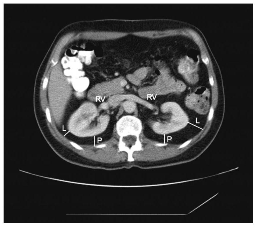 Method for automatically evaluating difficulty of kidney tumor enucleation based on CT (Computed Tomography) image