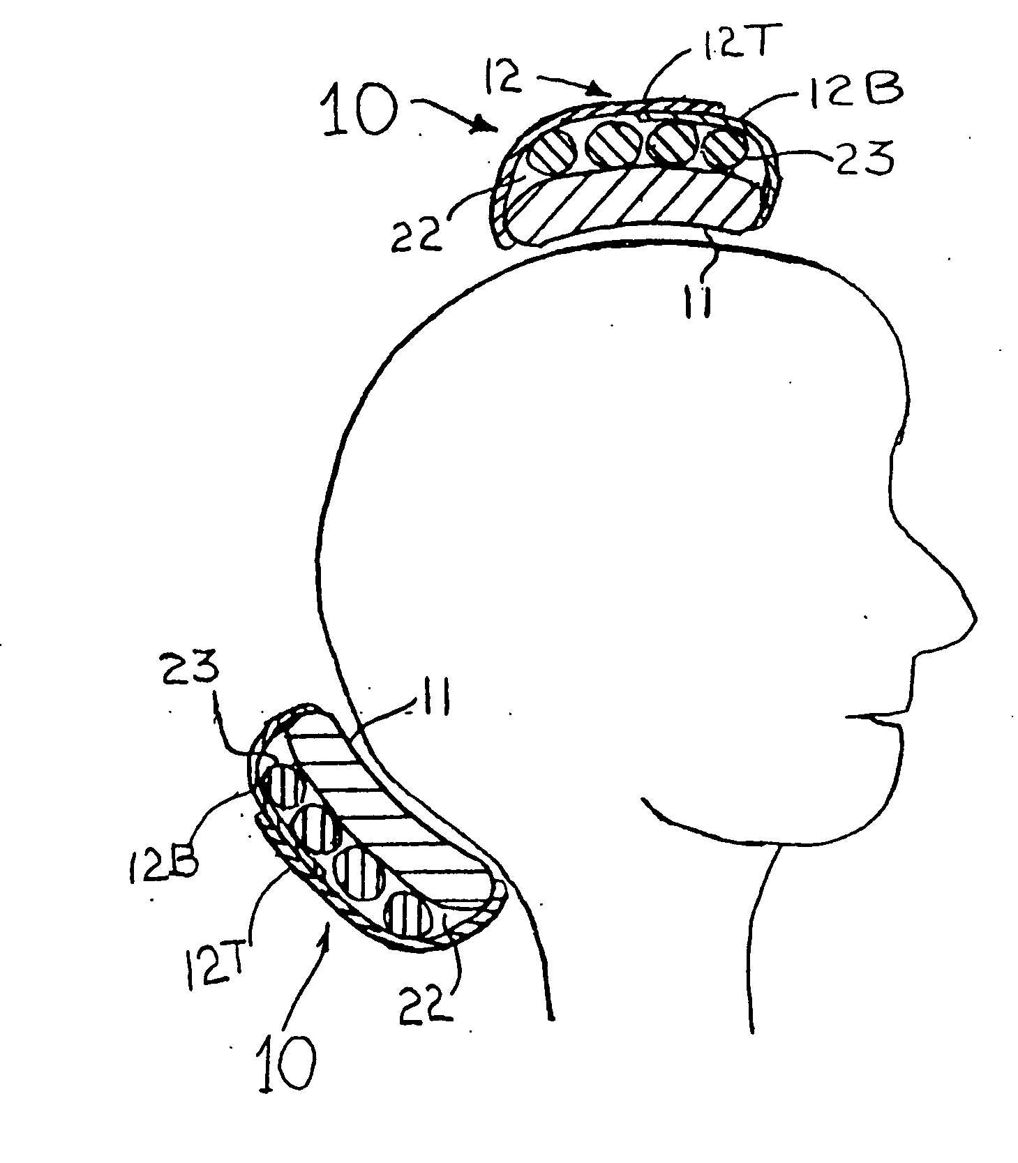 Means and methods for treating headaches