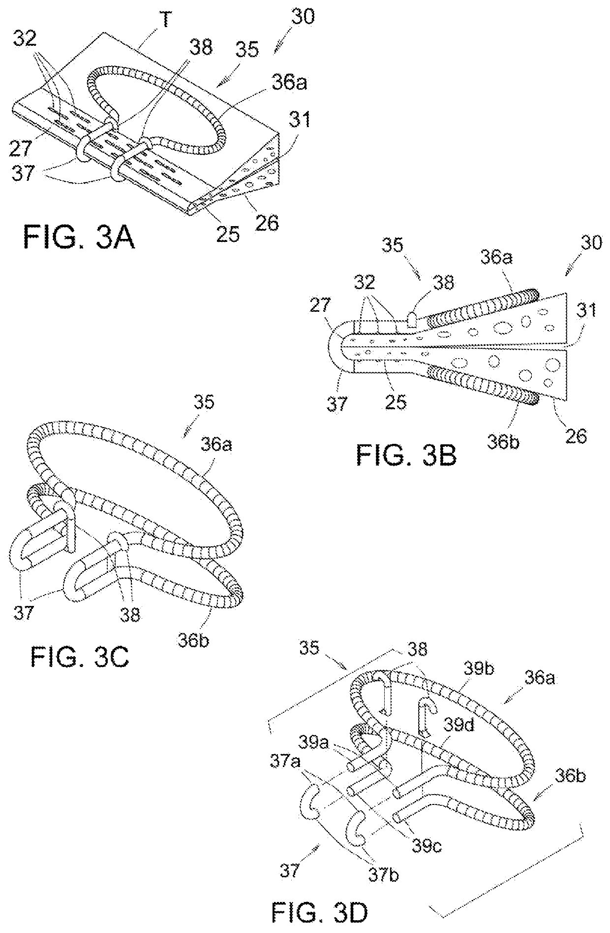 Surgical brace device for stapled tissue