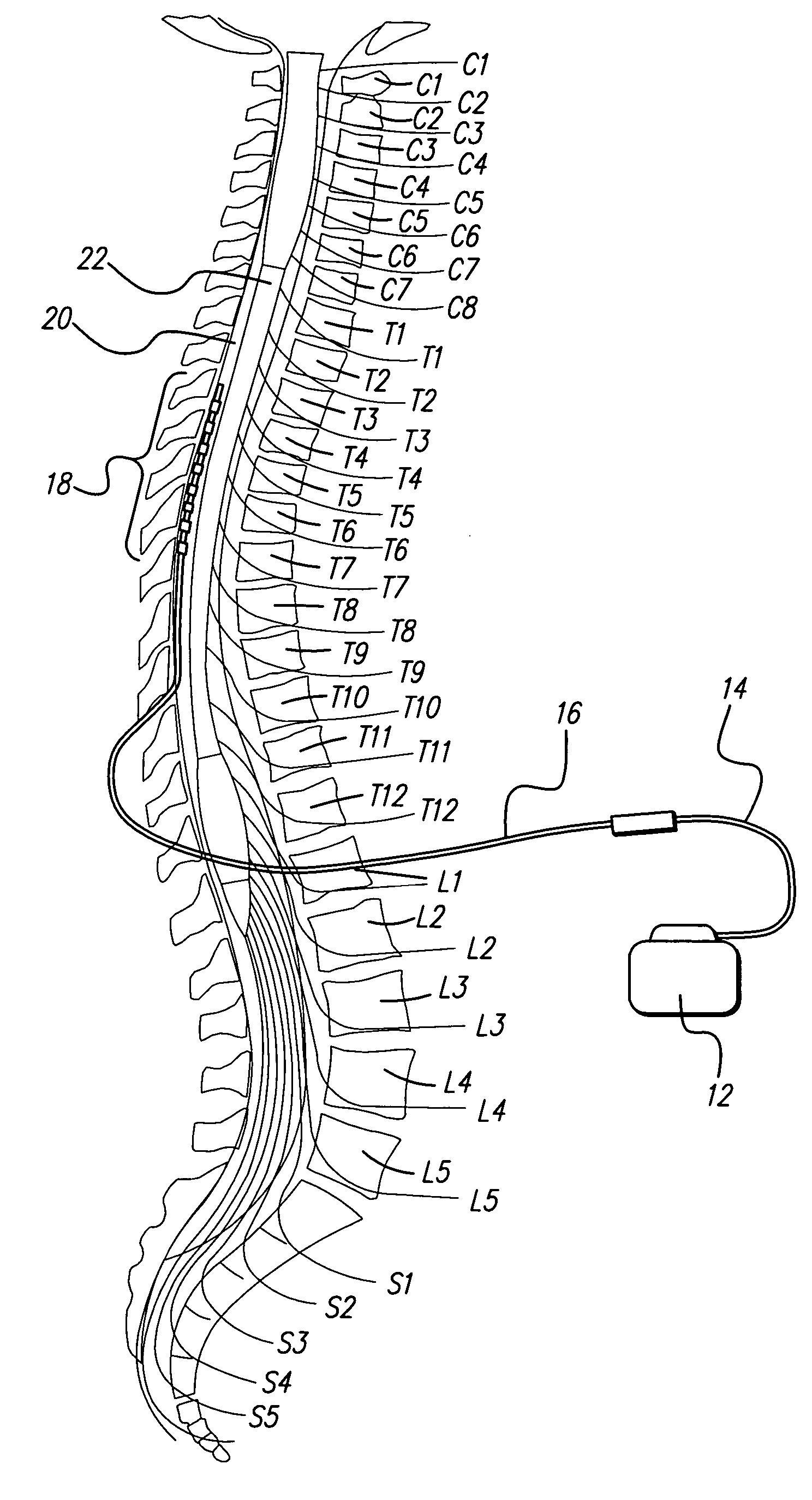 Method for optimizing location of implanted electrode array during implant surgery
