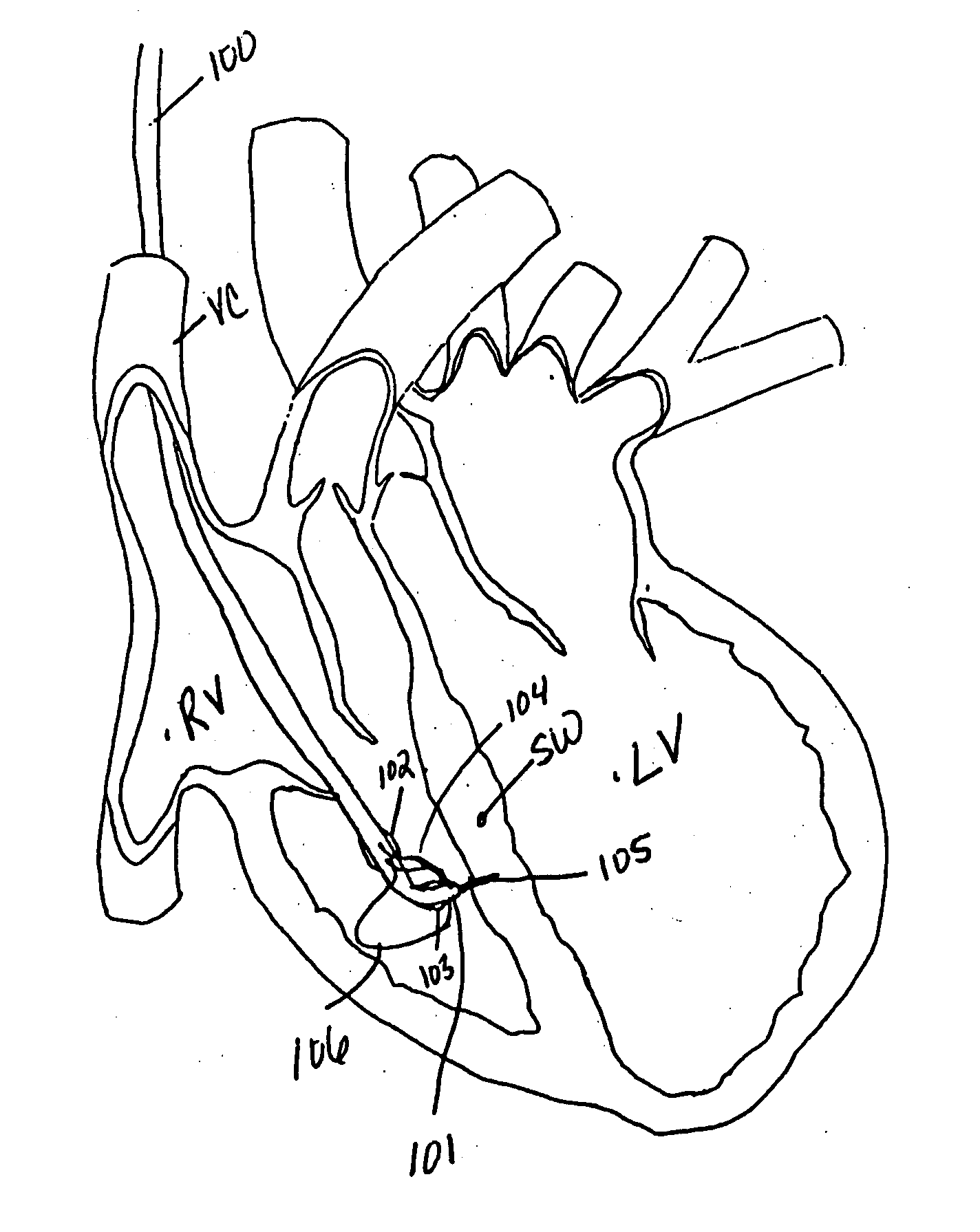 Endovascular splinting devices and methods