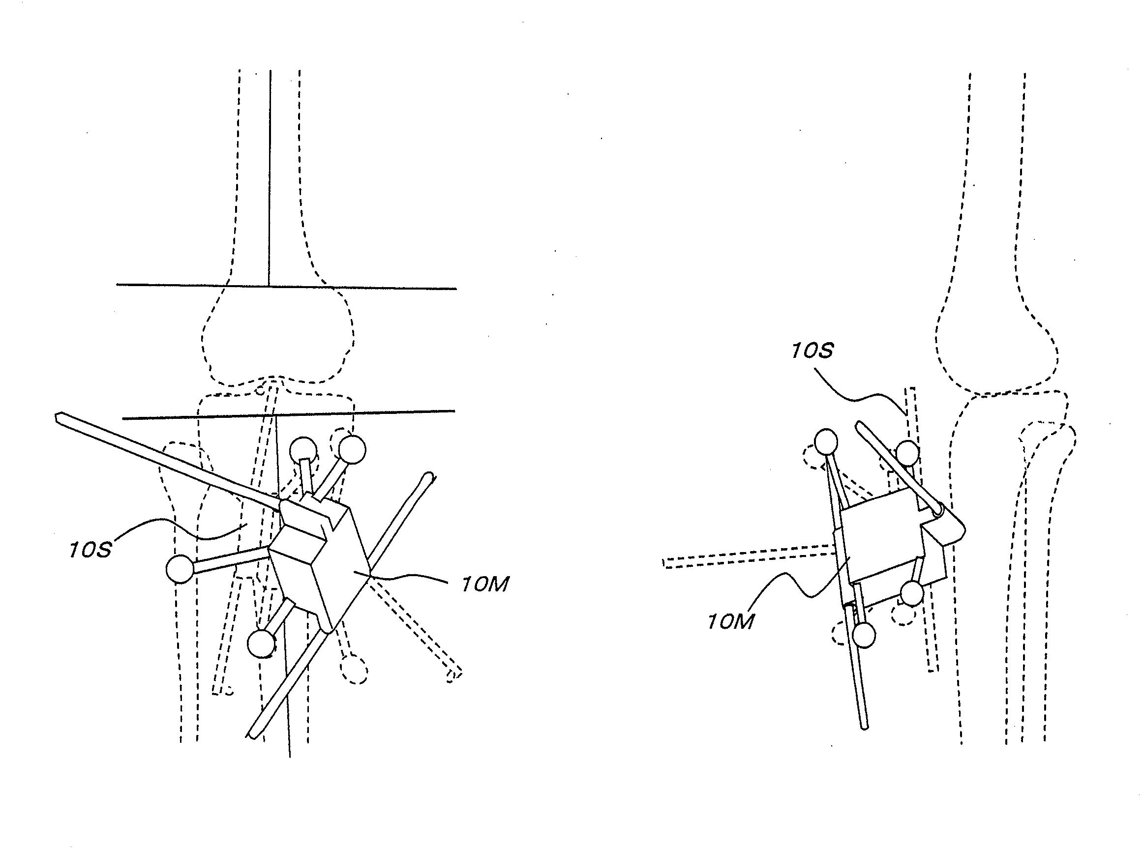Artificial joint replacement assisting device, artificial joint replacement assisting method using same, and assisting system