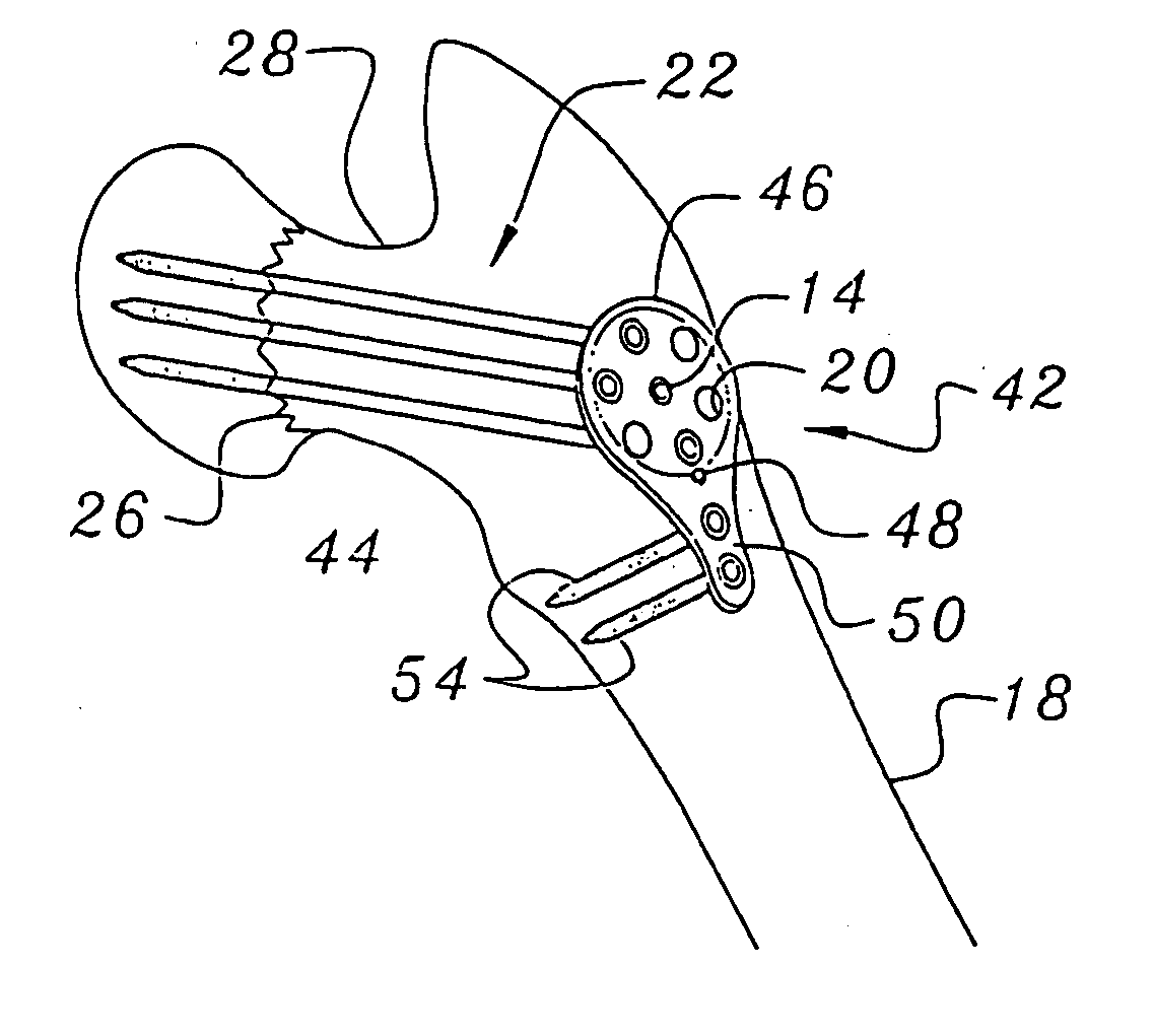 Bone end (Epiphysis) fracture fixation device and method of use