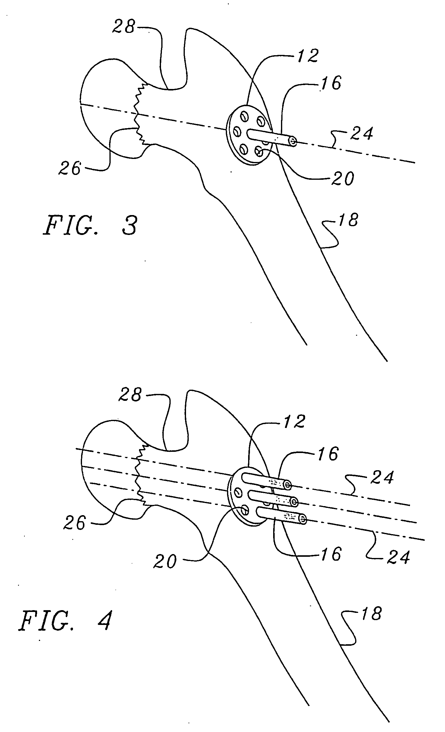 Bone end (Epiphysis) fracture fixation device and method of use