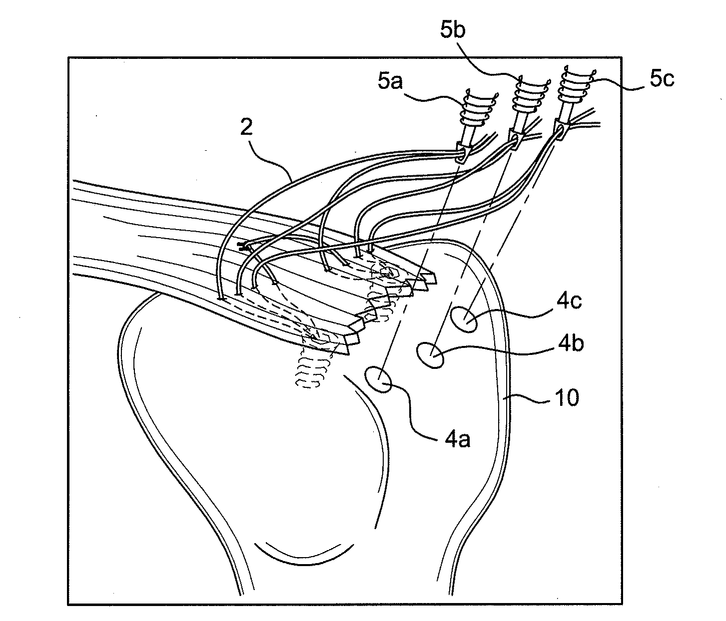 Method of knotless tissue fixation with criss-cross suture pattern