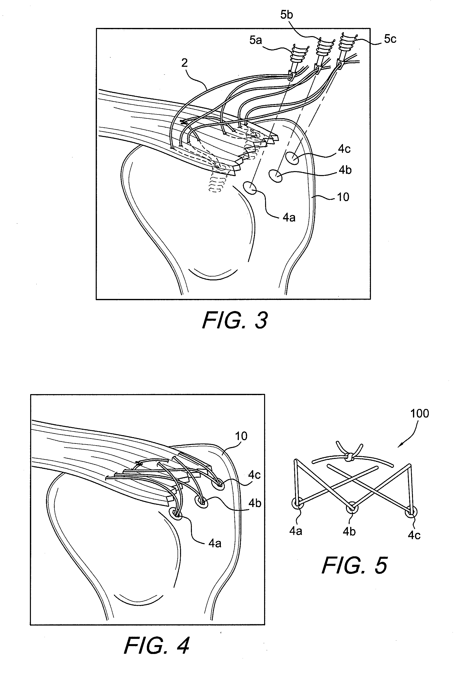 Method of knotless tissue fixation with criss-cross suture pattern