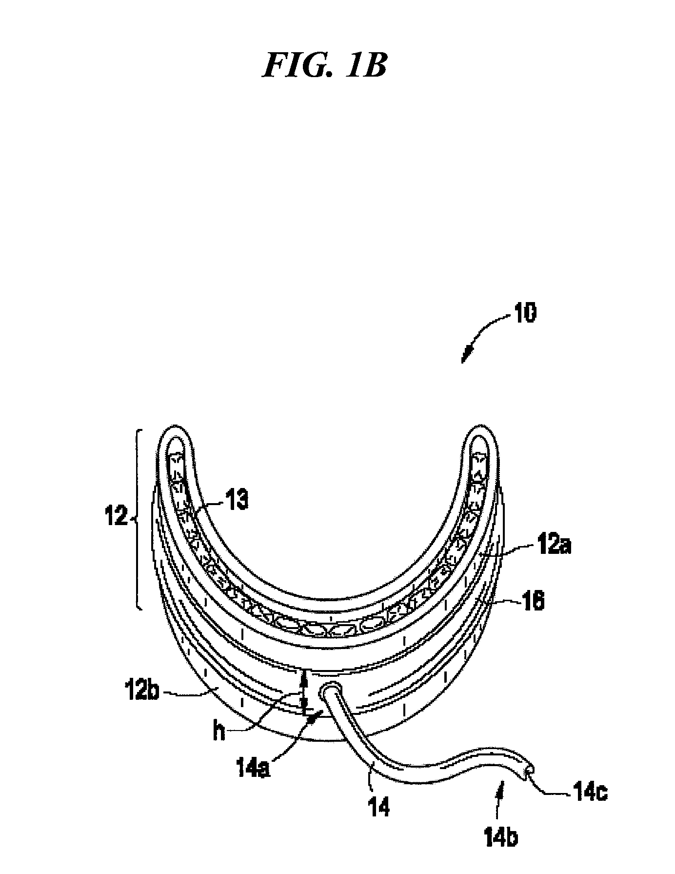 Methods and devices for relieving upper airway obstructions