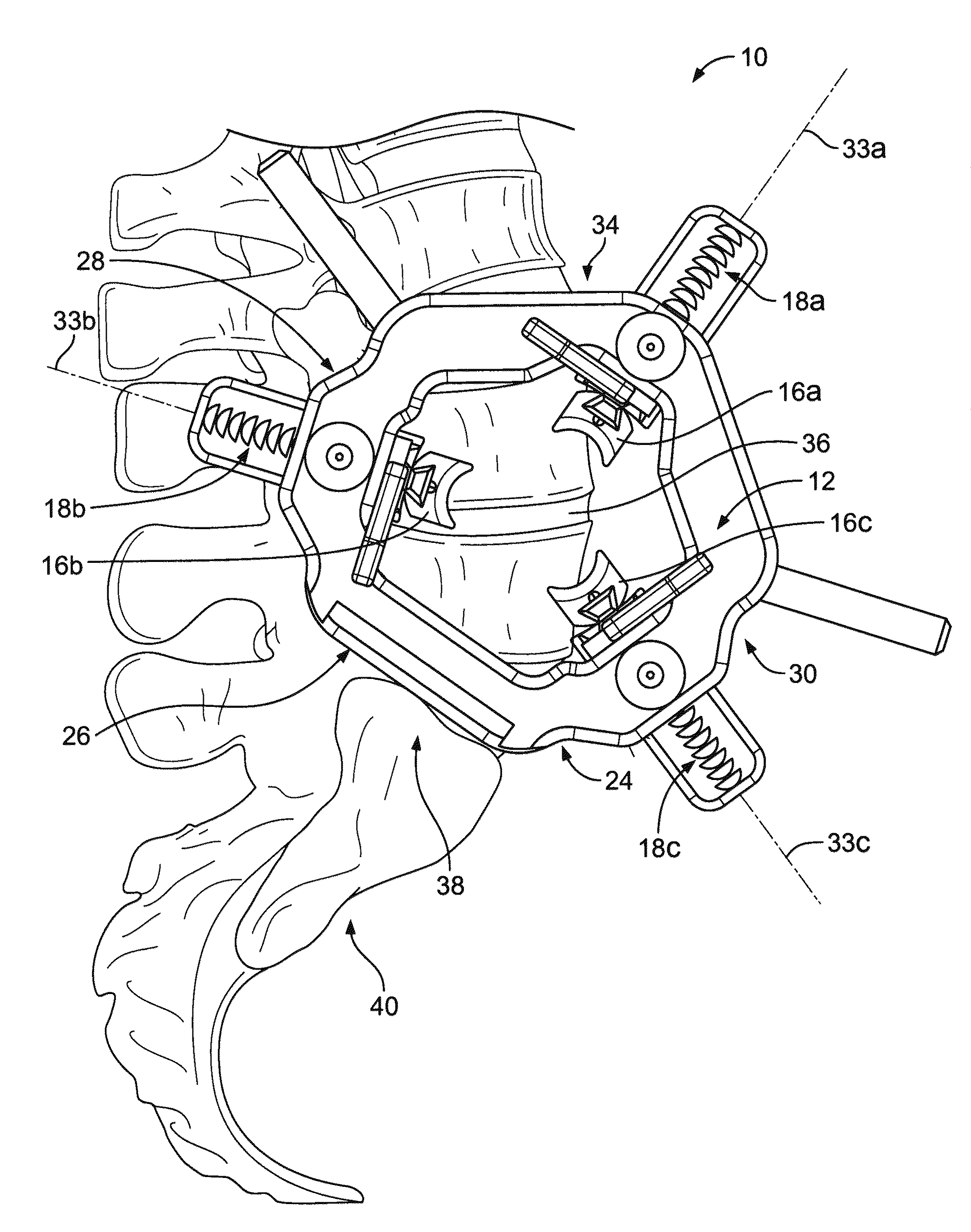Retraction Apparatus and Method of Use