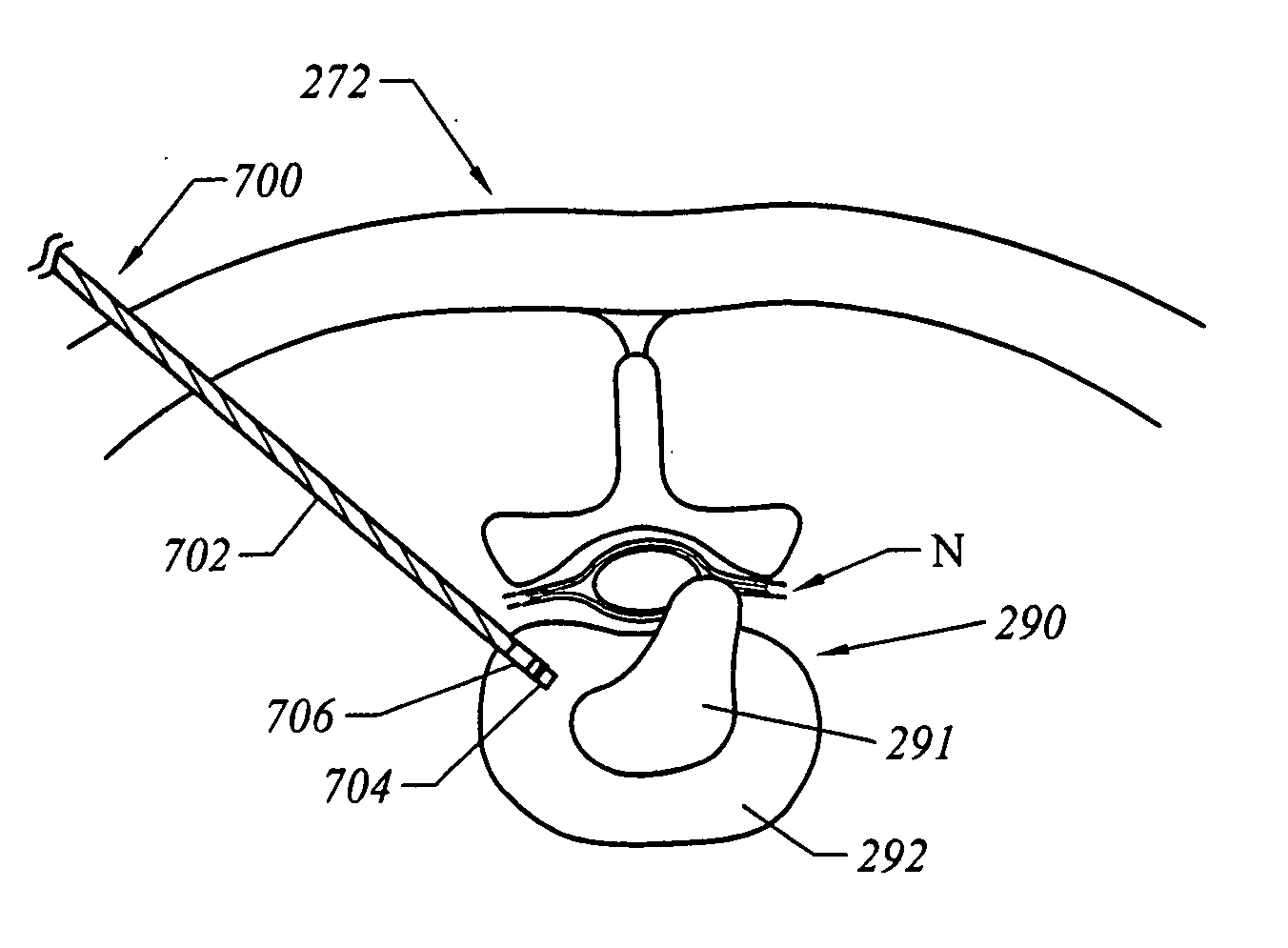 Methods for electrosurgical treatment of spinal tissue