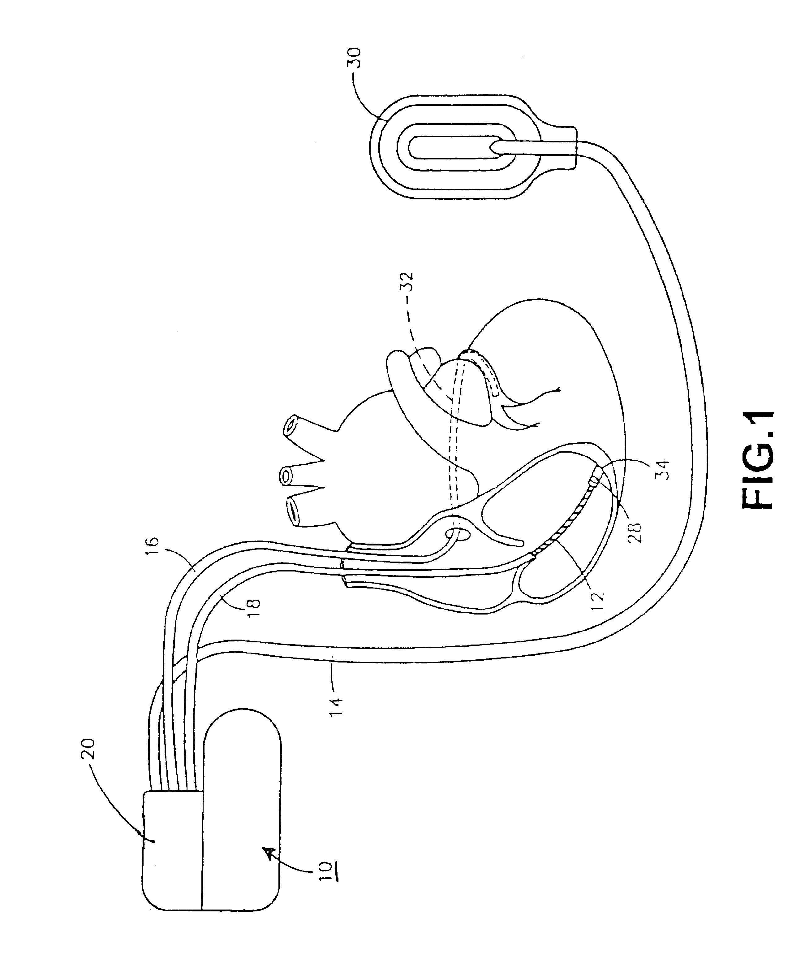 Implantable medical device having flat electrolytic capacitor with differing sized anode and cathode layers