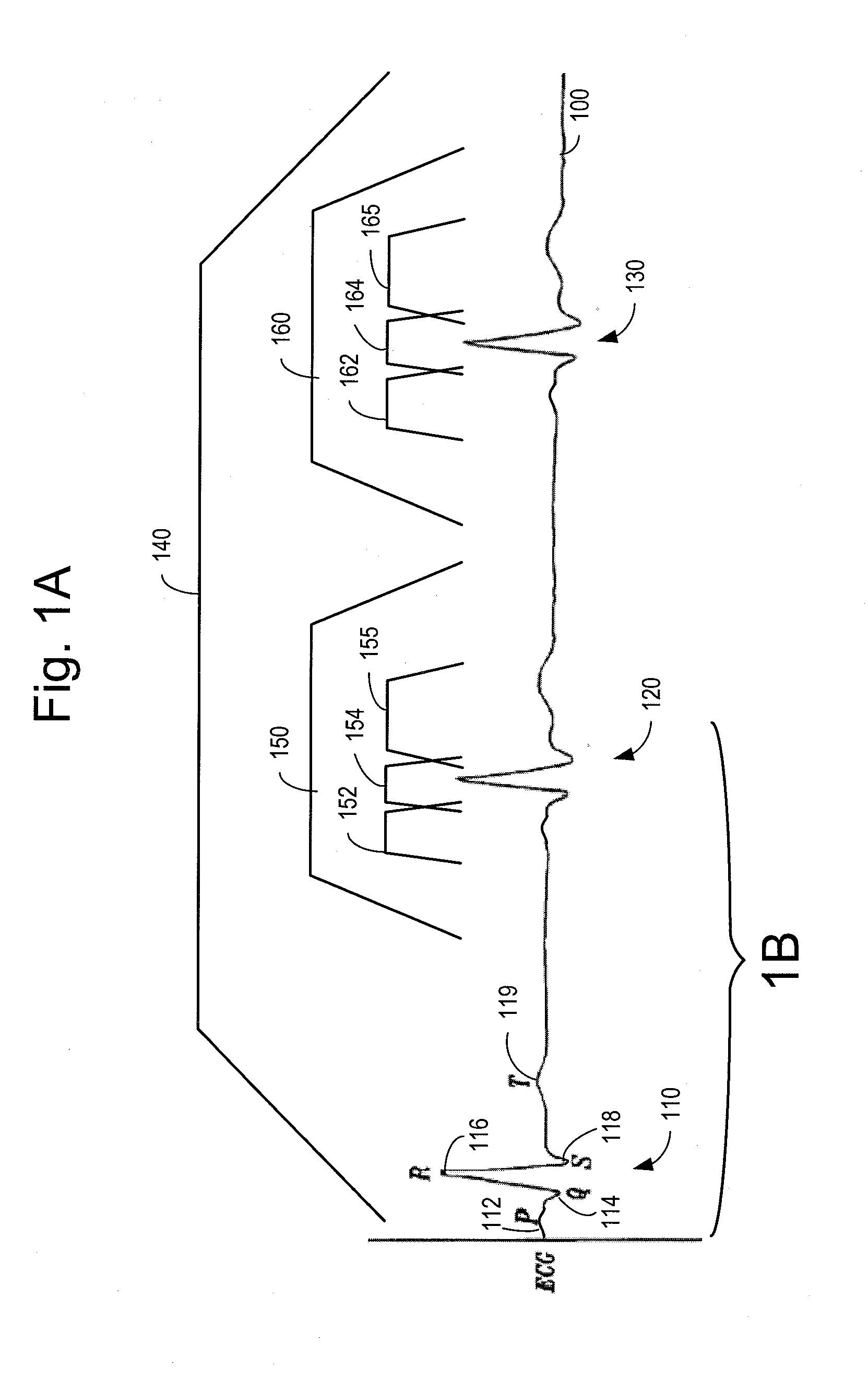 Cardiac Activation Sequence Monitoring for Ischemia Detection