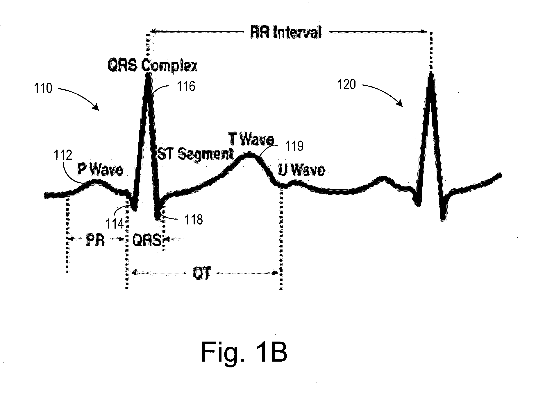 Cardiac Activation Sequence Monitoring for Ischemia Detection