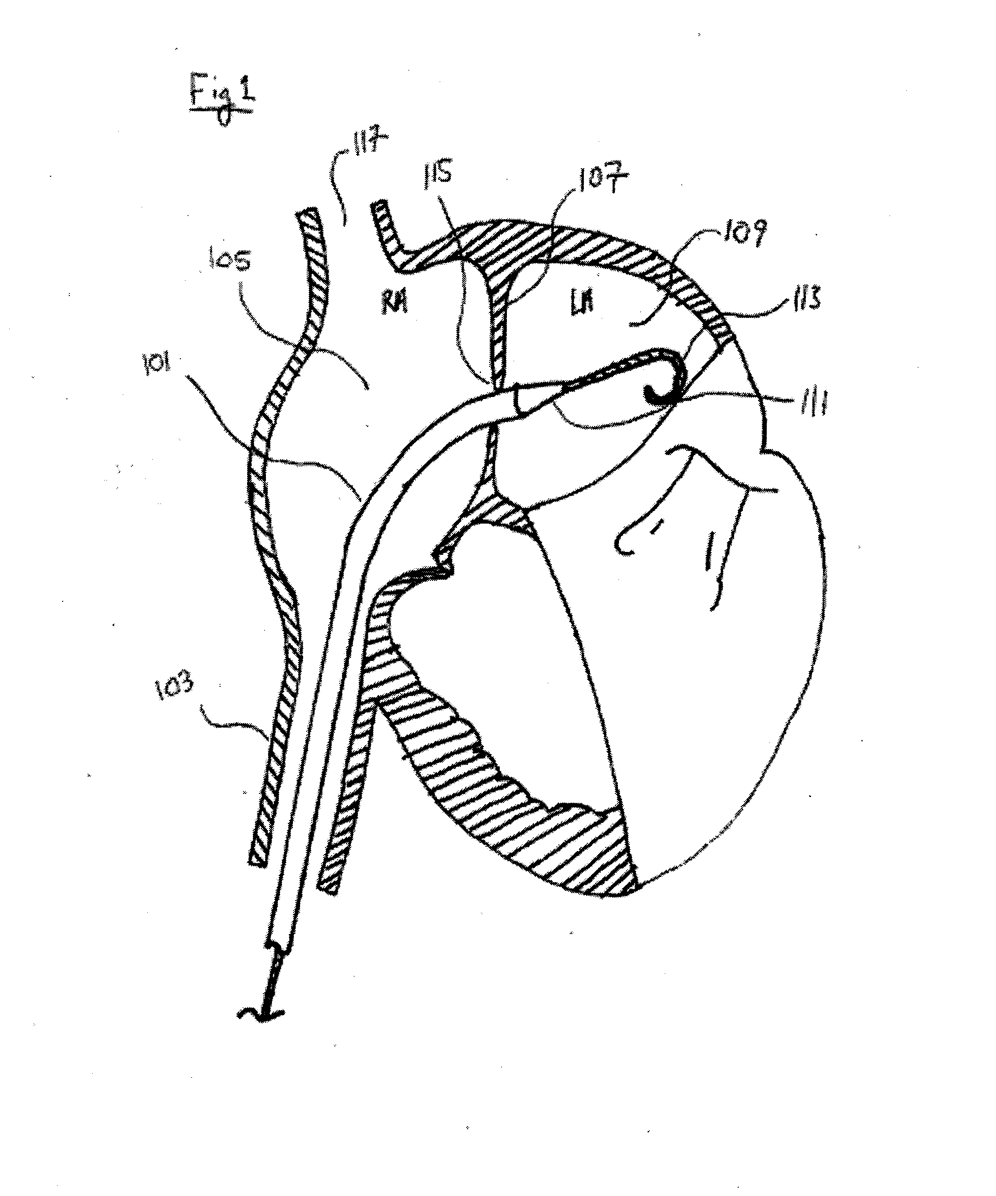 Methods and devices for intra-atrial shunts having adjustable sizes