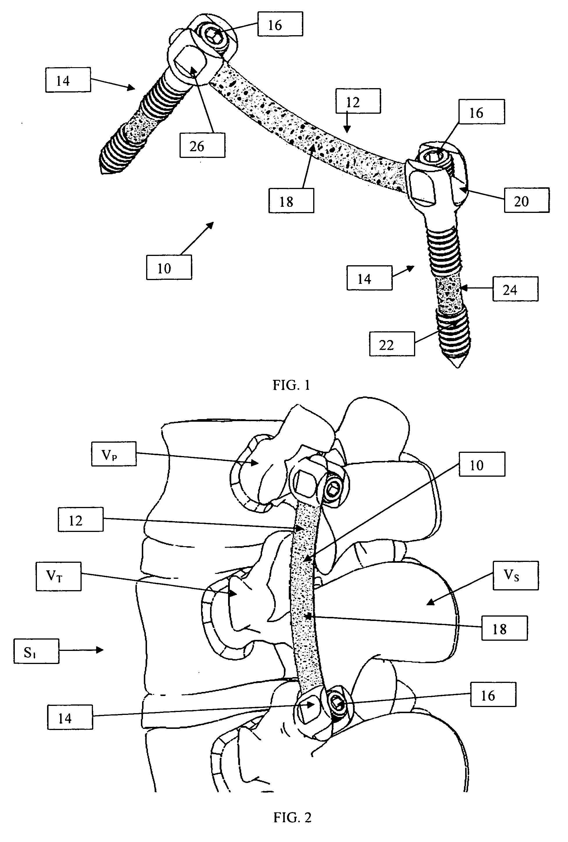 Osteoconductive spinal fixation system