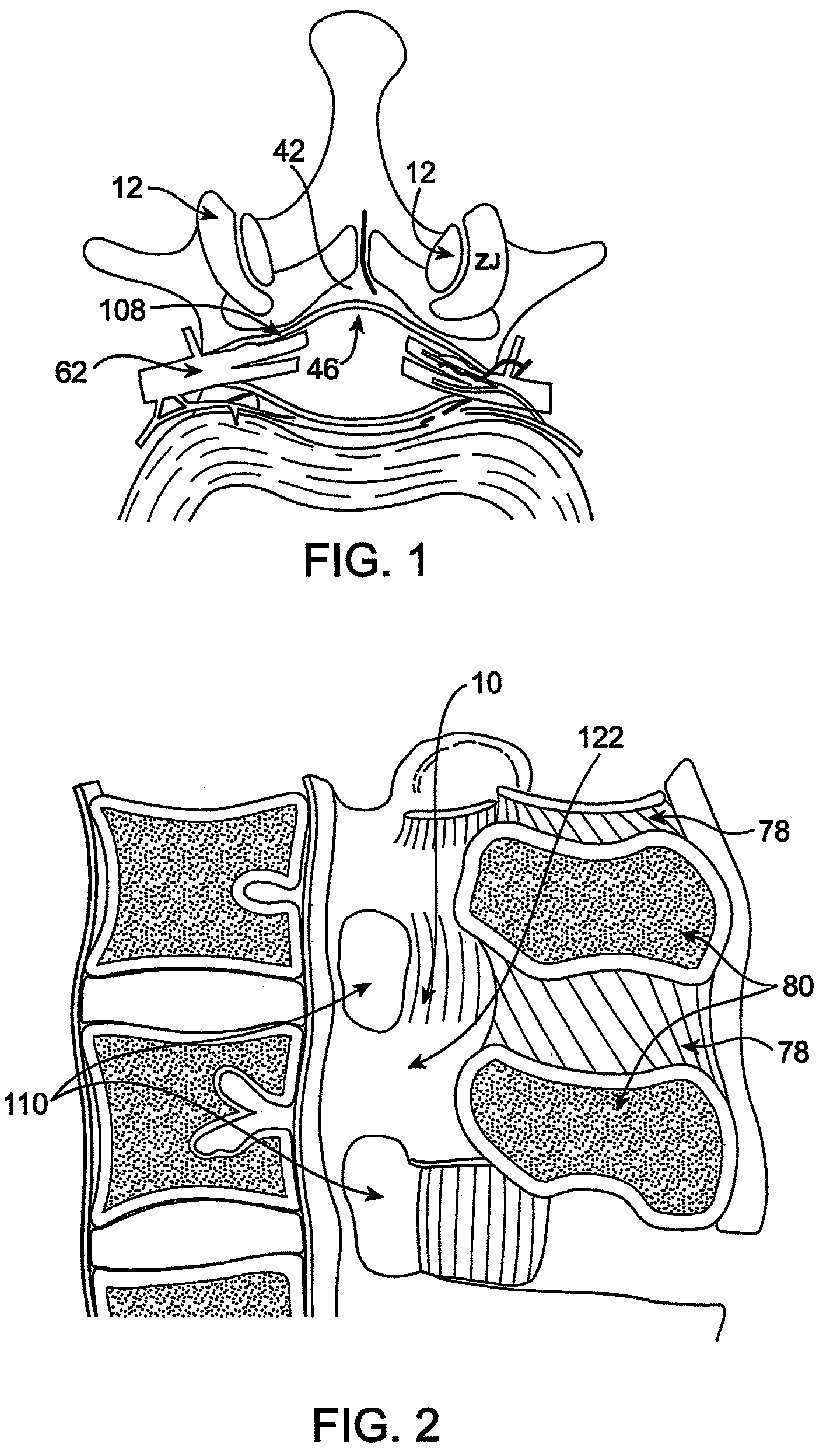 Devices and methods for selective surgical removal of tissue