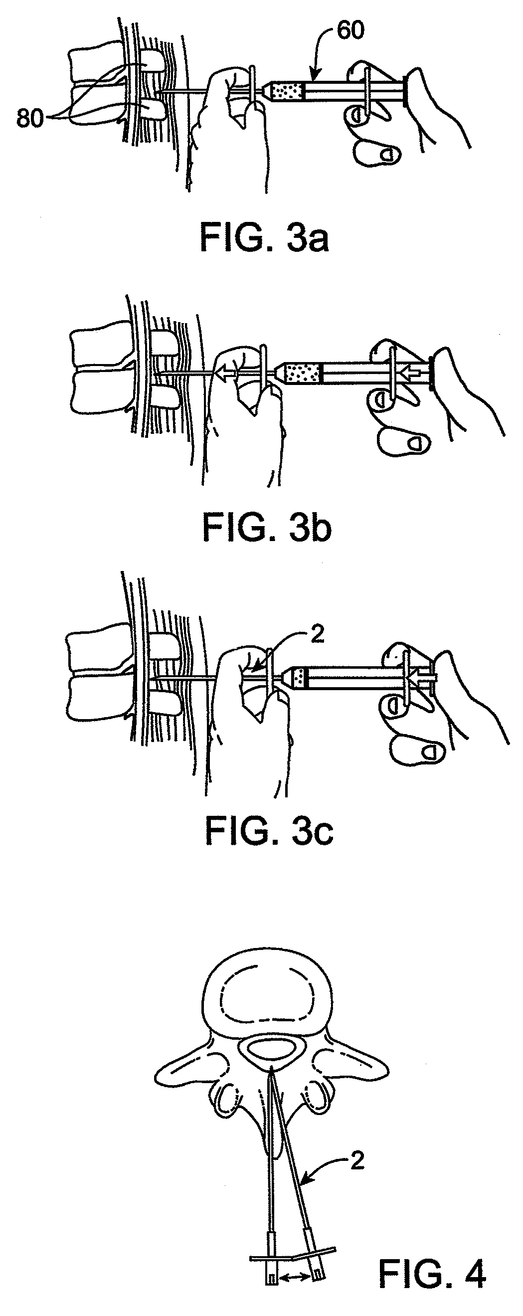 Devices and methods for selective surgical removal of tissue