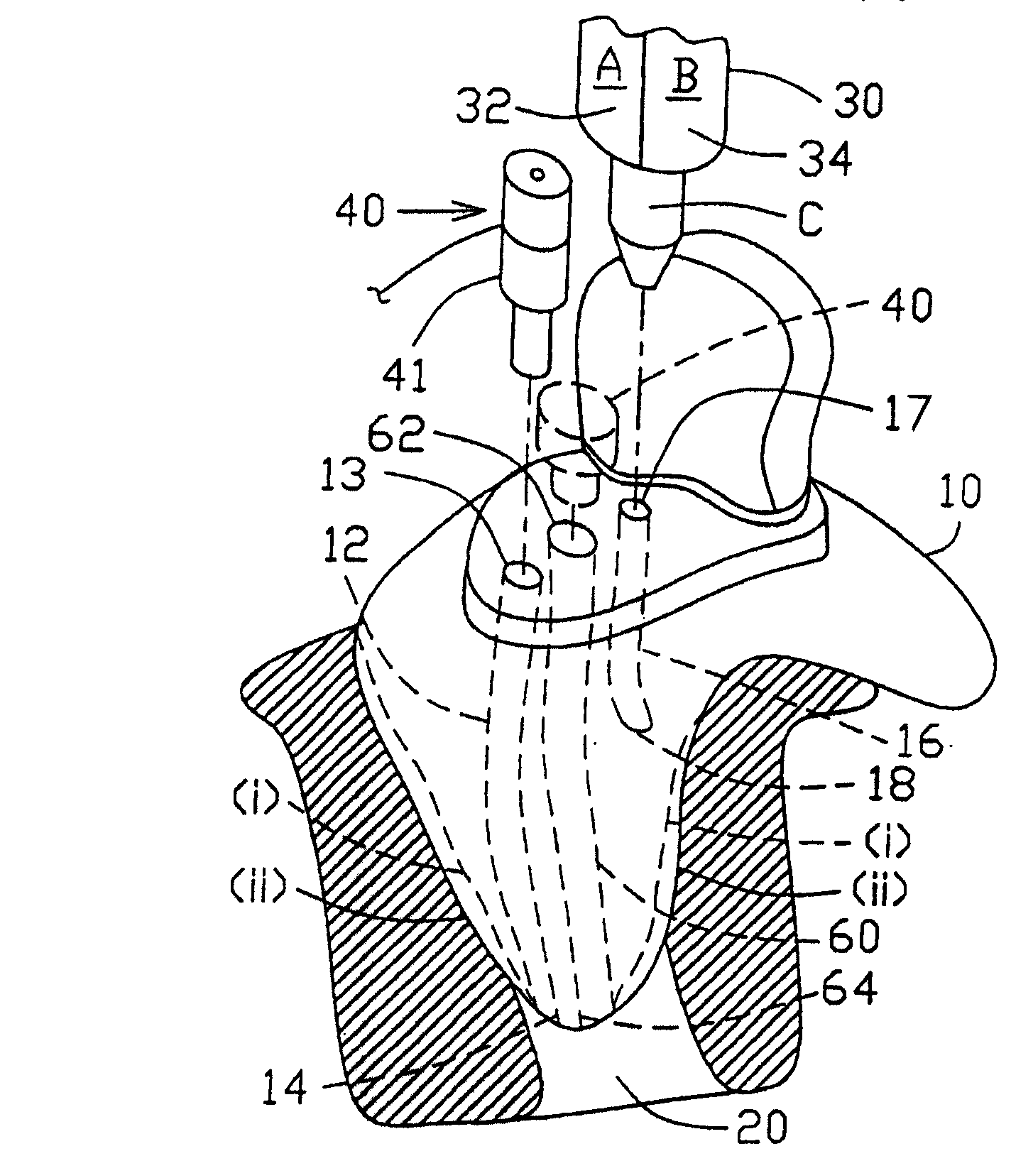 Method and apparatus for determining in situ the acoustic seal provided by an in-ear device