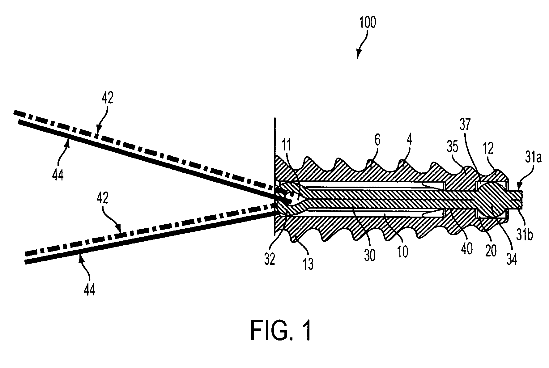 Fully-threaded bioabsorbable suture anchor