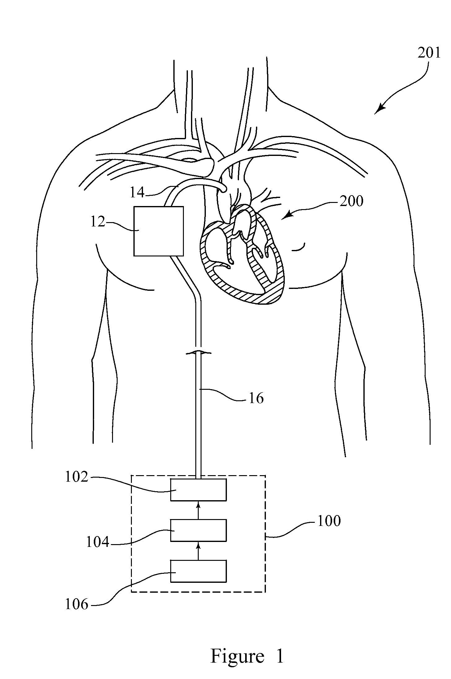 System and method for providing cardiac support and promoting myocardial recovery