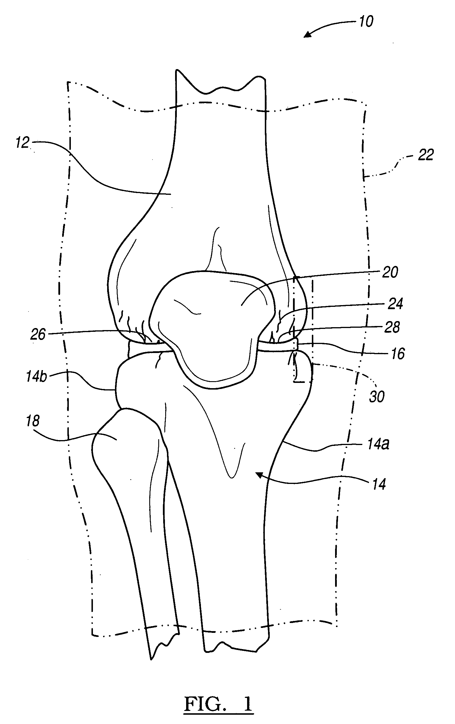 Instrumentation for knee resection