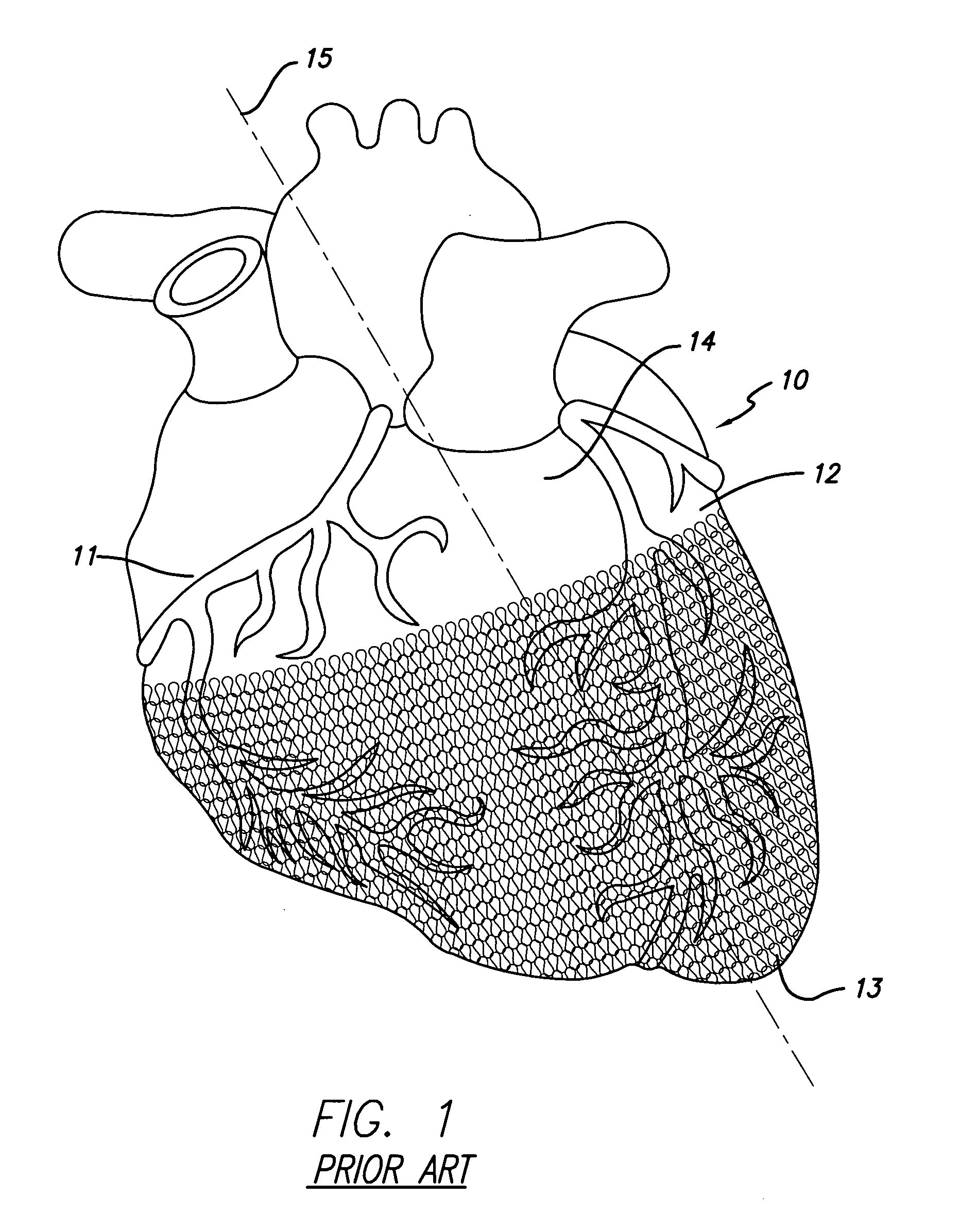 Cardiac harness and method of delivery by minimally invasive access