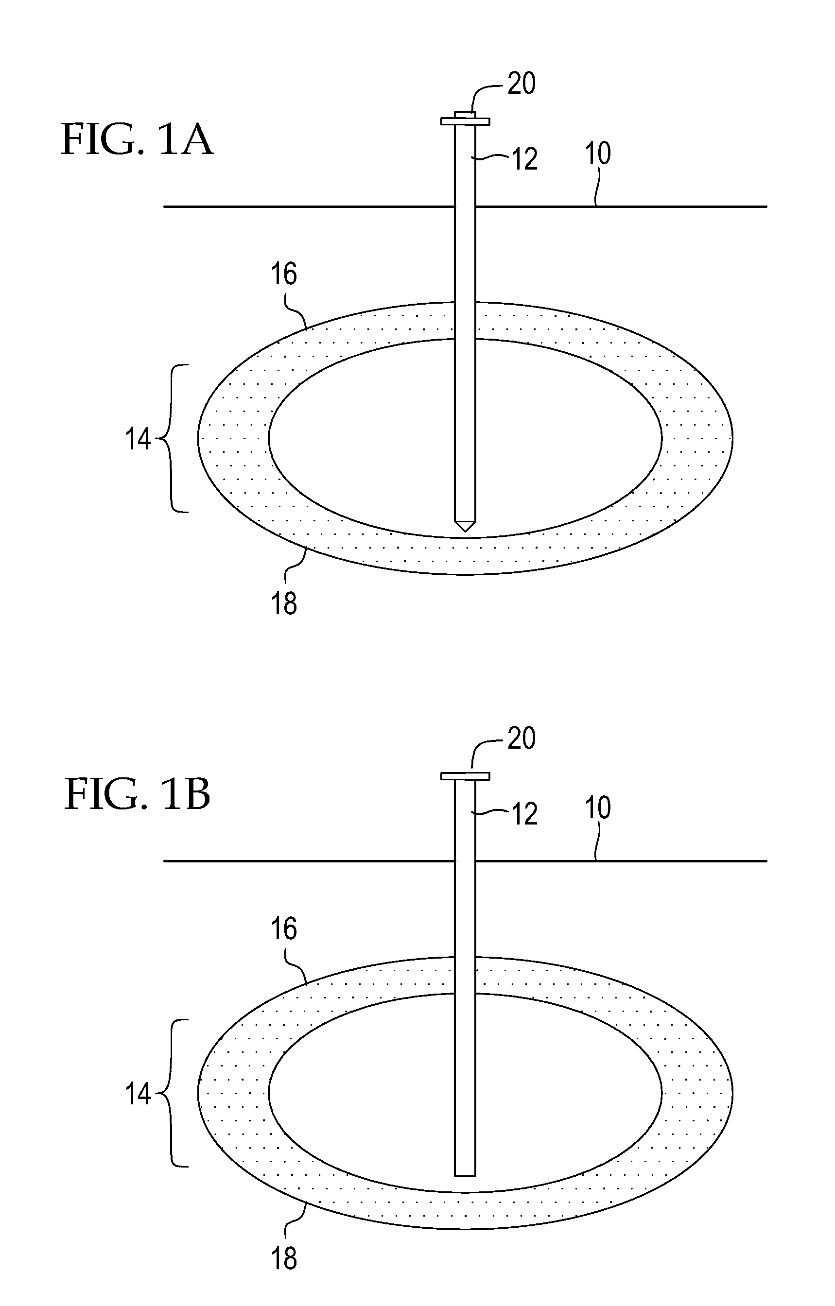 Minimally Invasive Percutaneous Restrictive Bariatric Procedure And Related Device