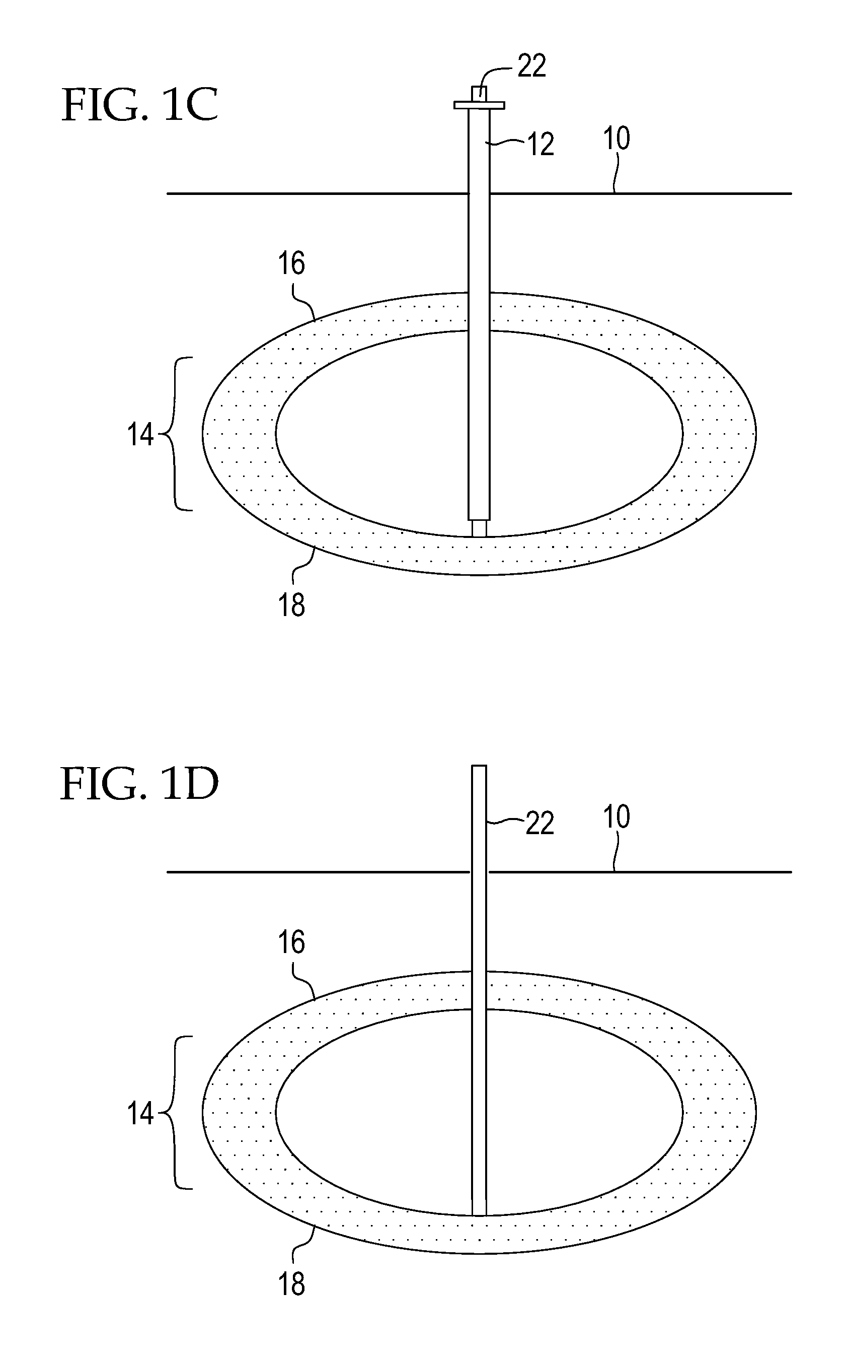 Minimally Invasive Percutaneous Restrictive Bariatric Procedure And Related Device