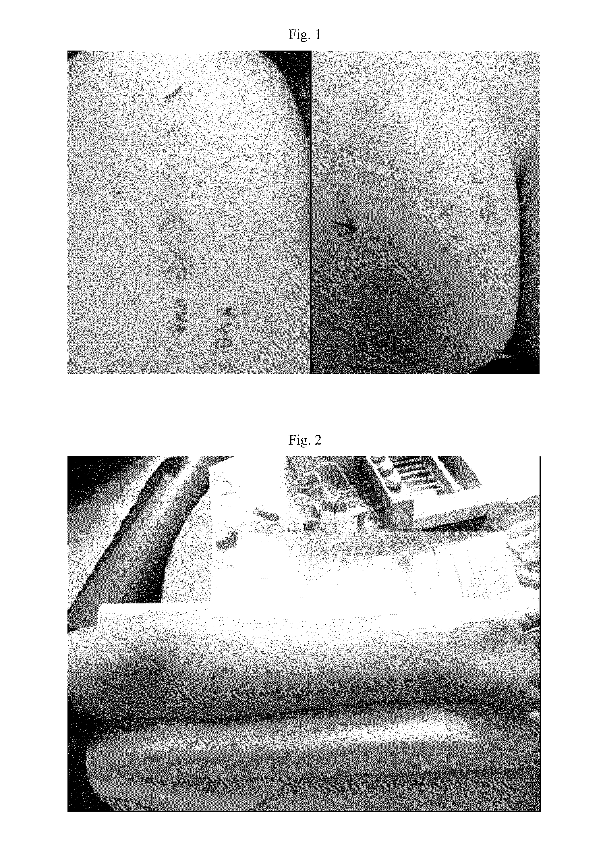 Pharmaceutical Composition for the Treatment of Solar Urticaria