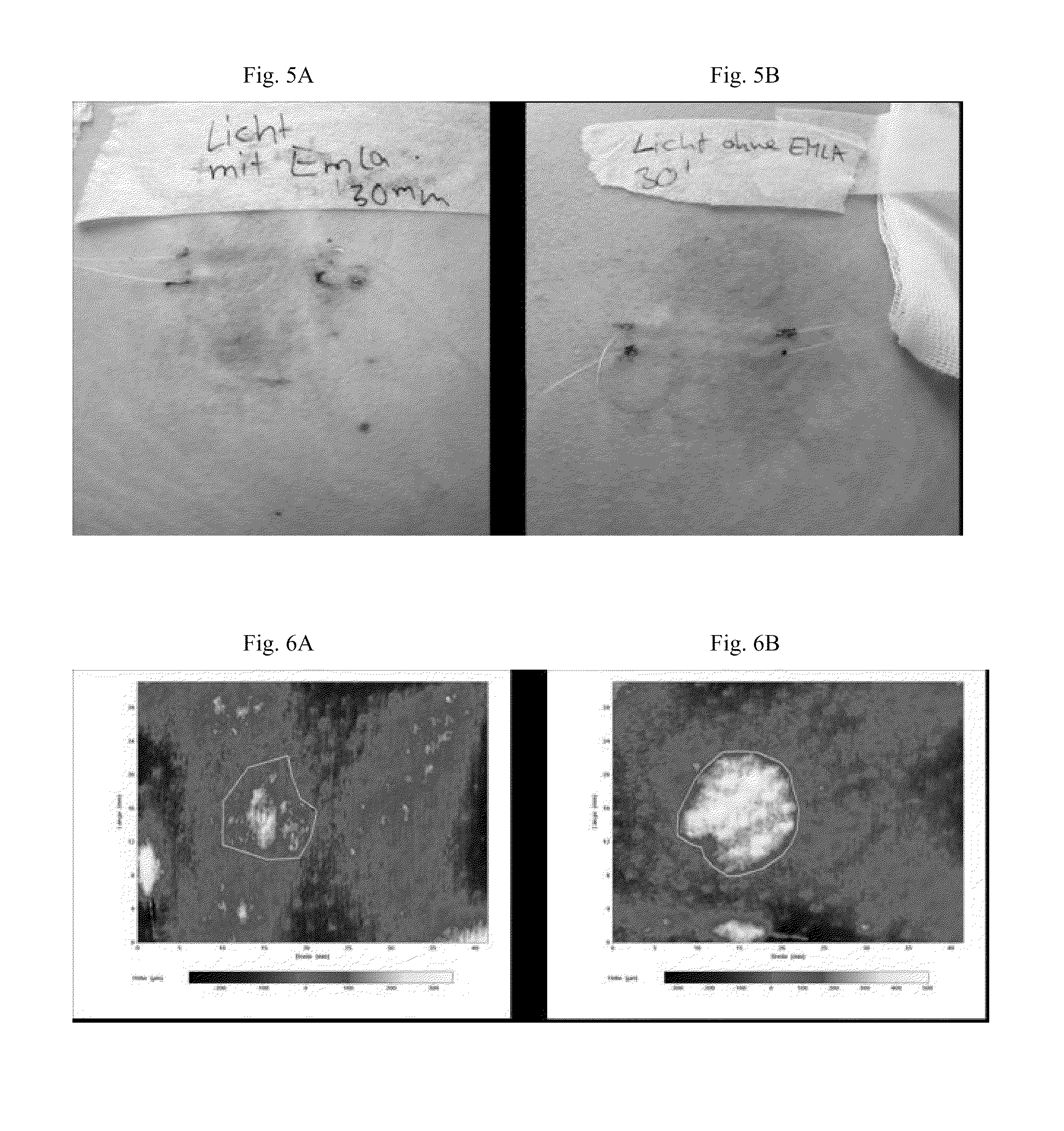 Pharmaceutical Composition for the Treatment of Solar Urticaria