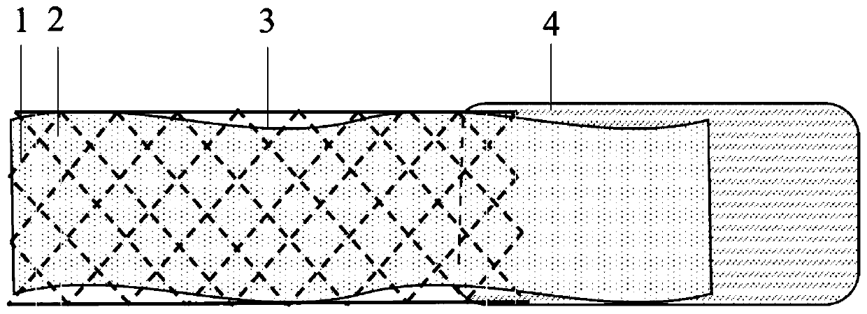 Degradable intestinal stent for rectal anastomosis protection