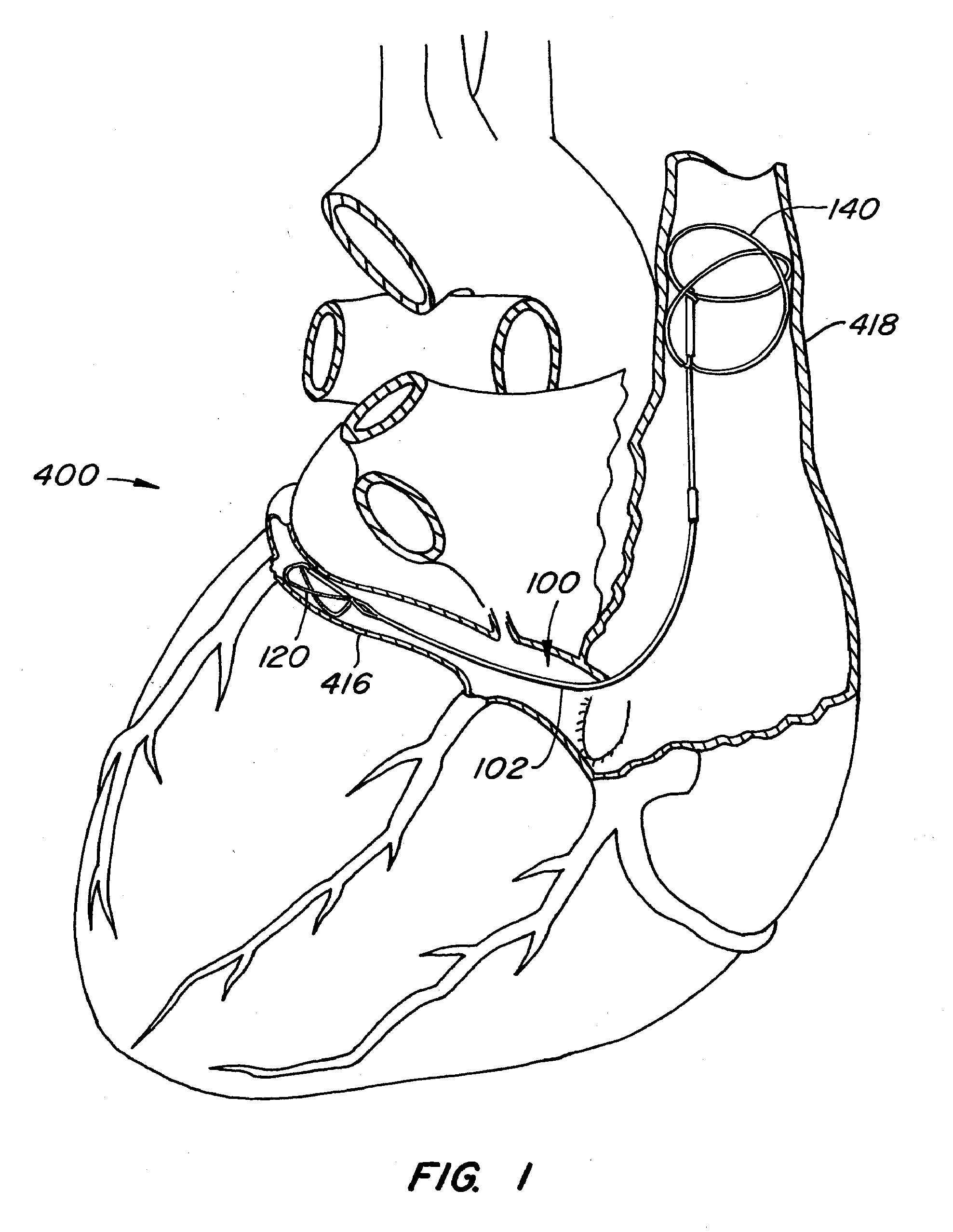 Mitral Valve Annuloplasty Device with Vena Cava Anchor