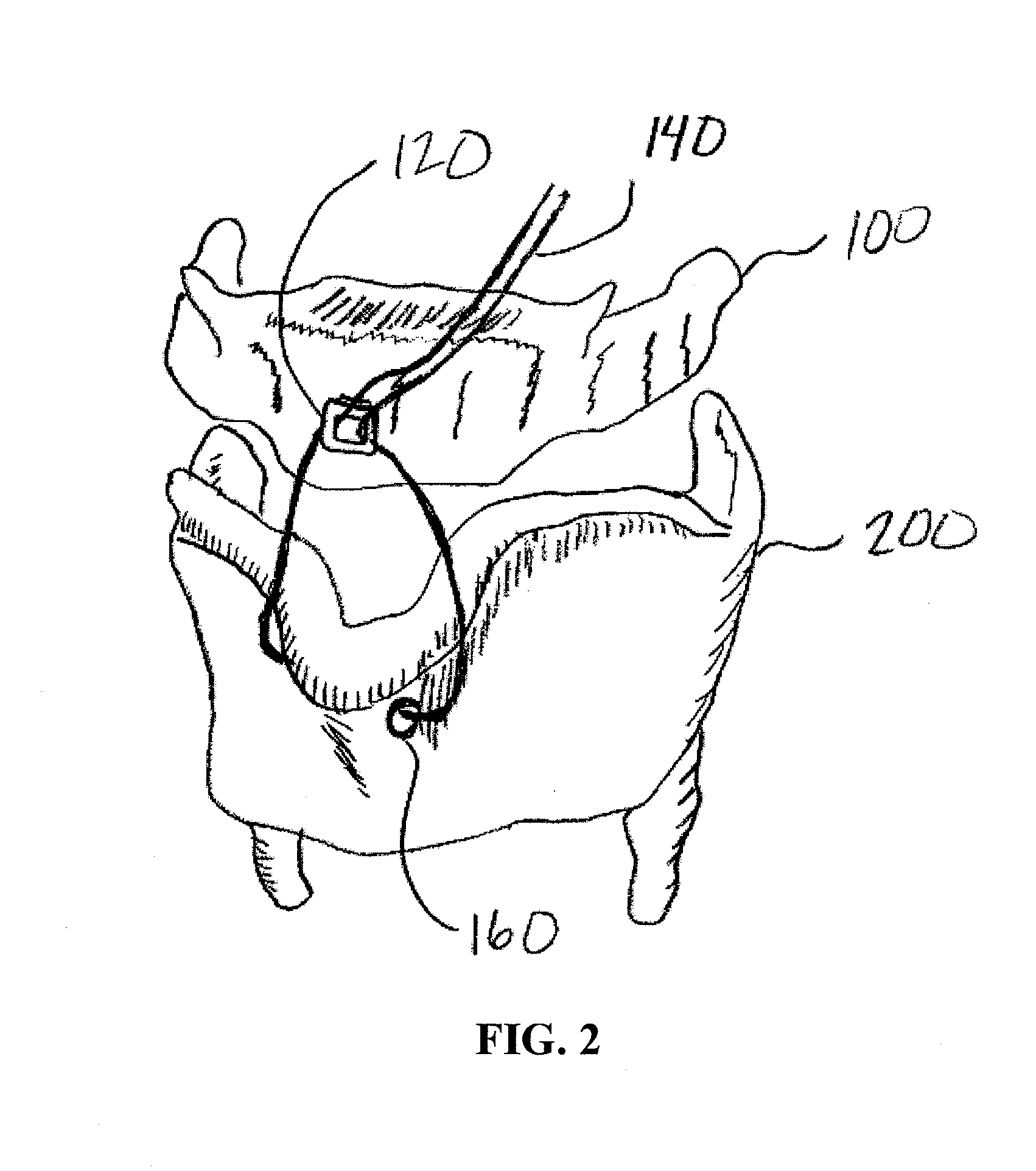 Method and system for displacing hyoid bone