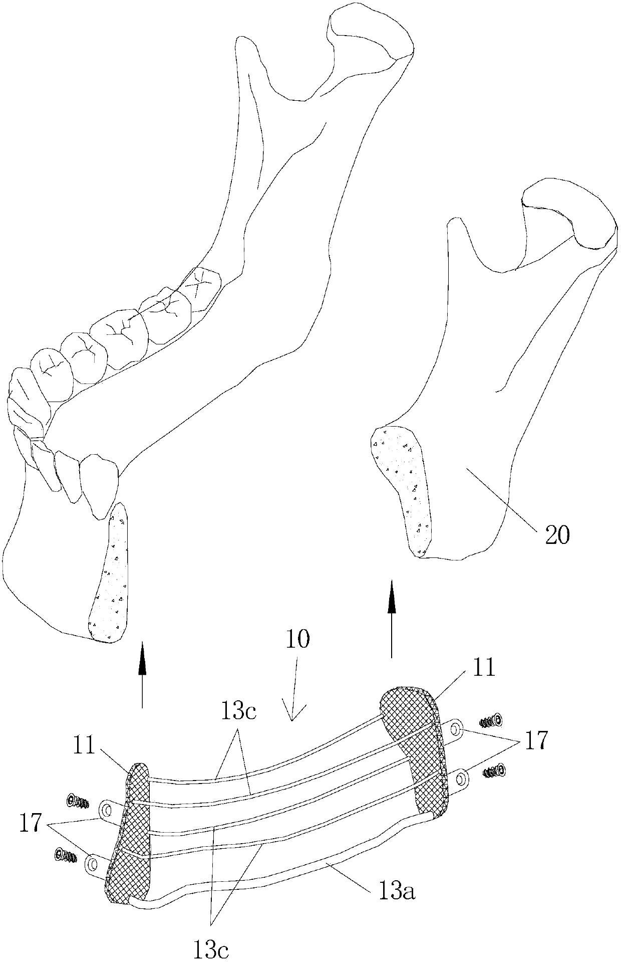 Bone defect repairing device