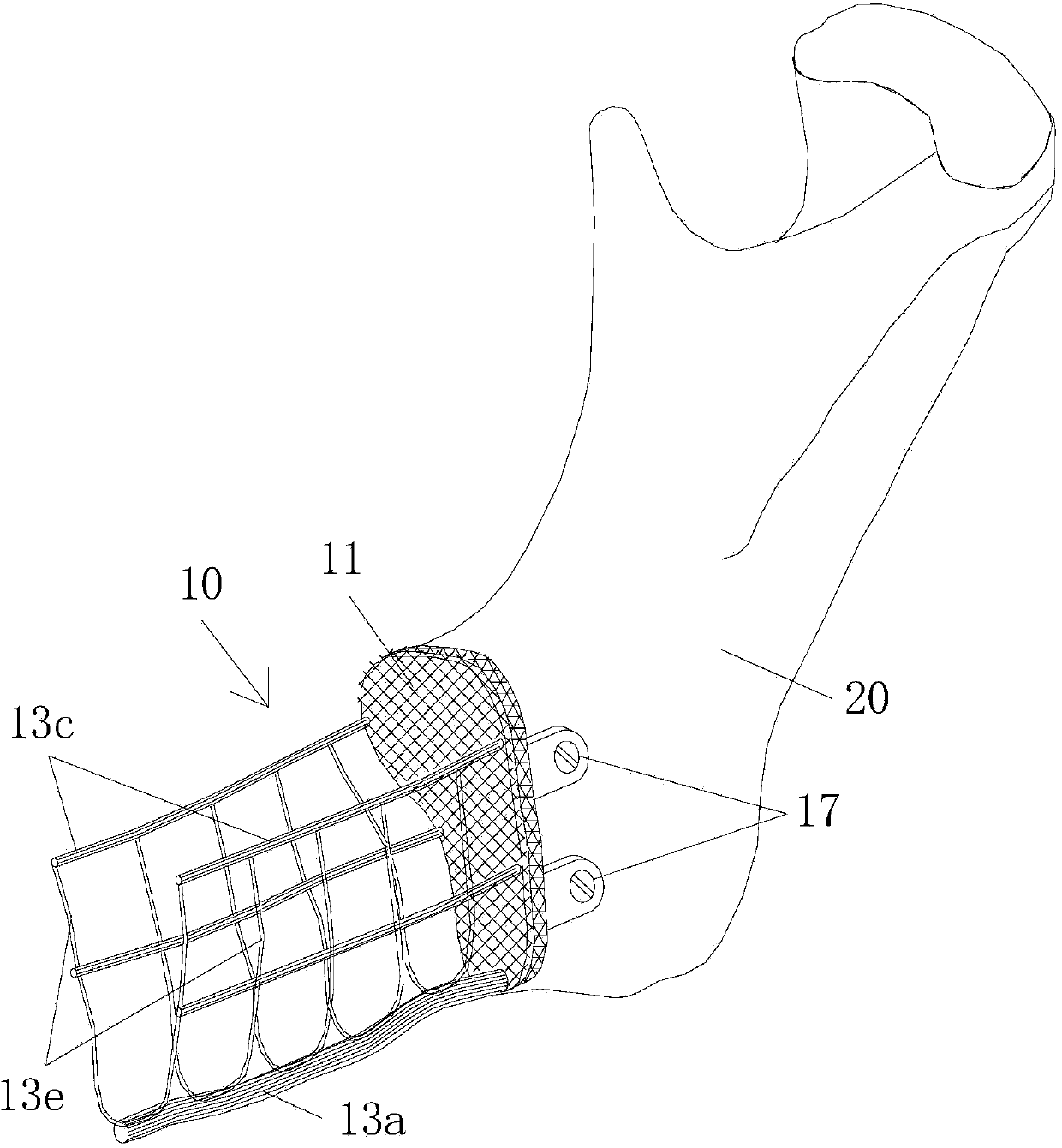 Bone defect repairing device