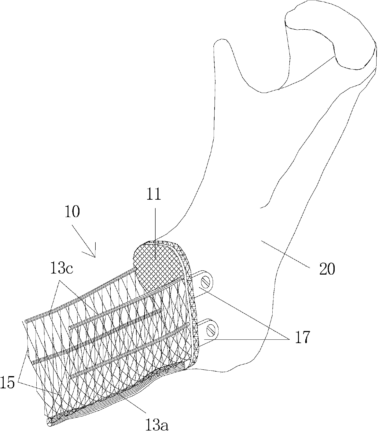 Bone defect repairing device