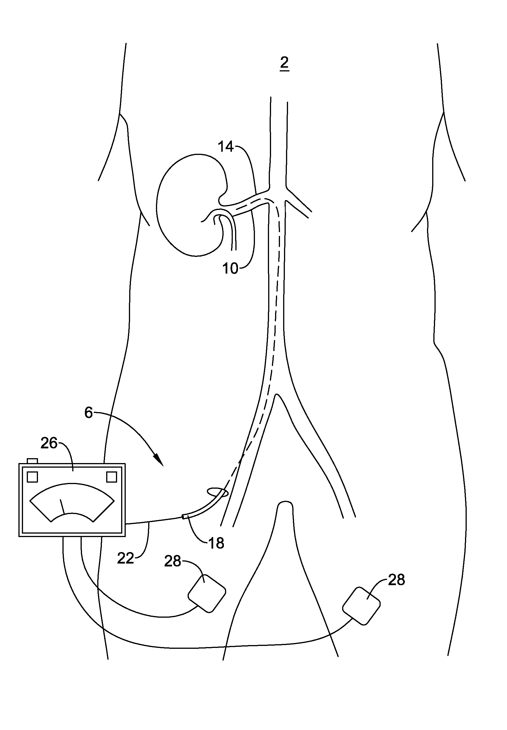 Catheter having rib and spine structure supporting multiple electrodes for renal nerve ablation