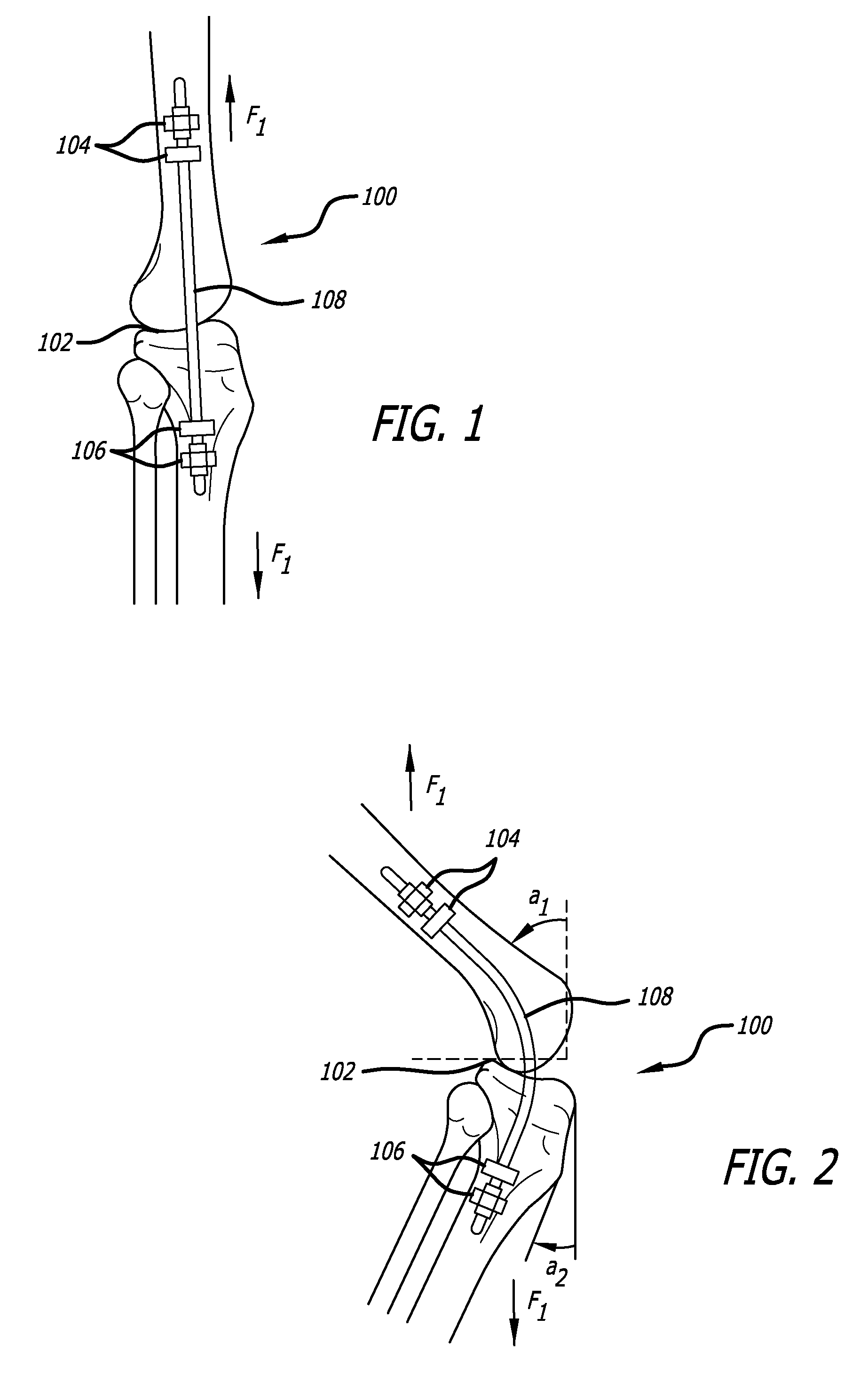 Extra-Articular Implantable Mechanical Energy Absorbing Systems