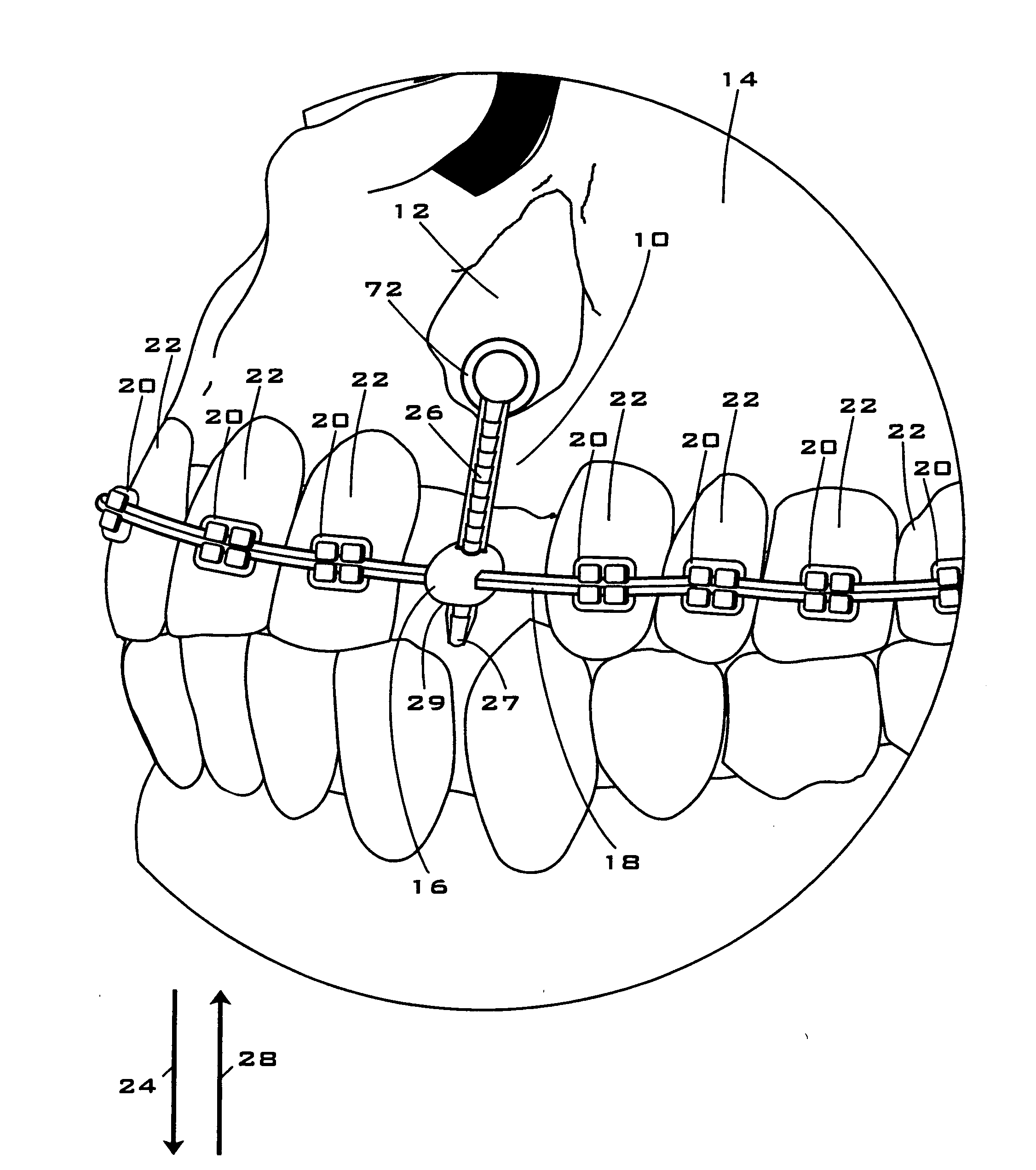 Apparatus for moving a misplaced or impacted tooth