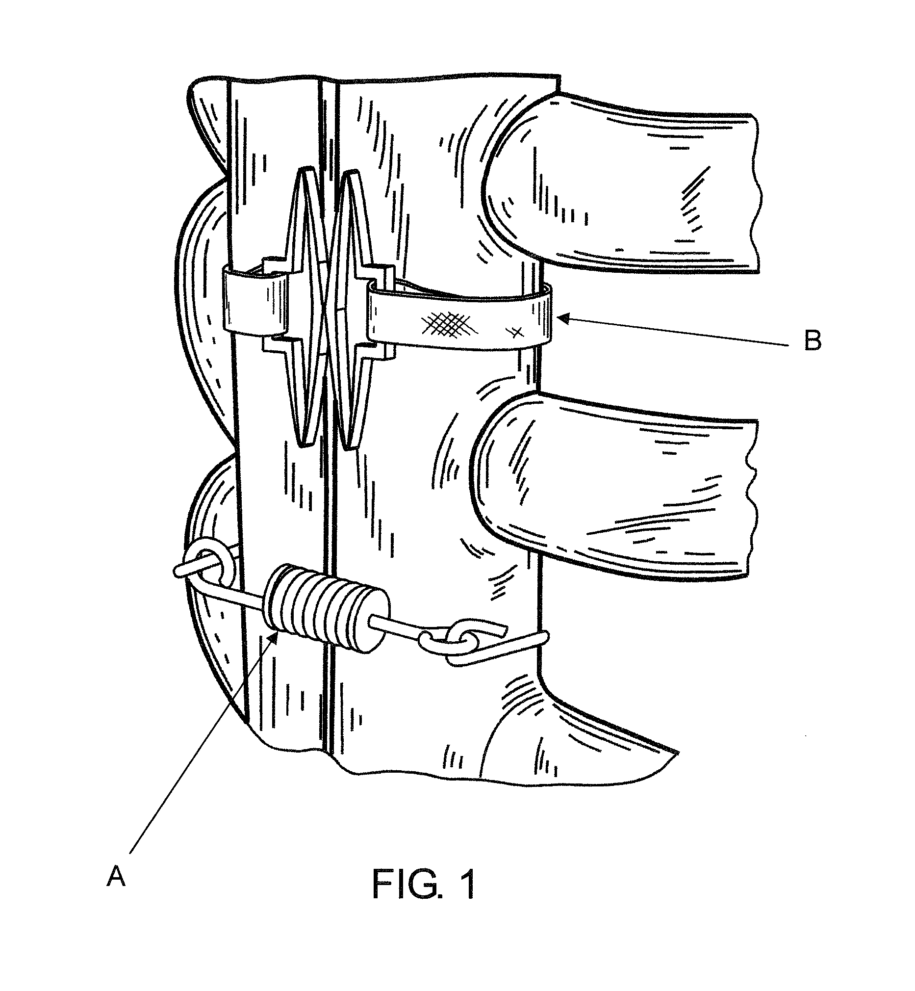 Flat suture banding system and methods